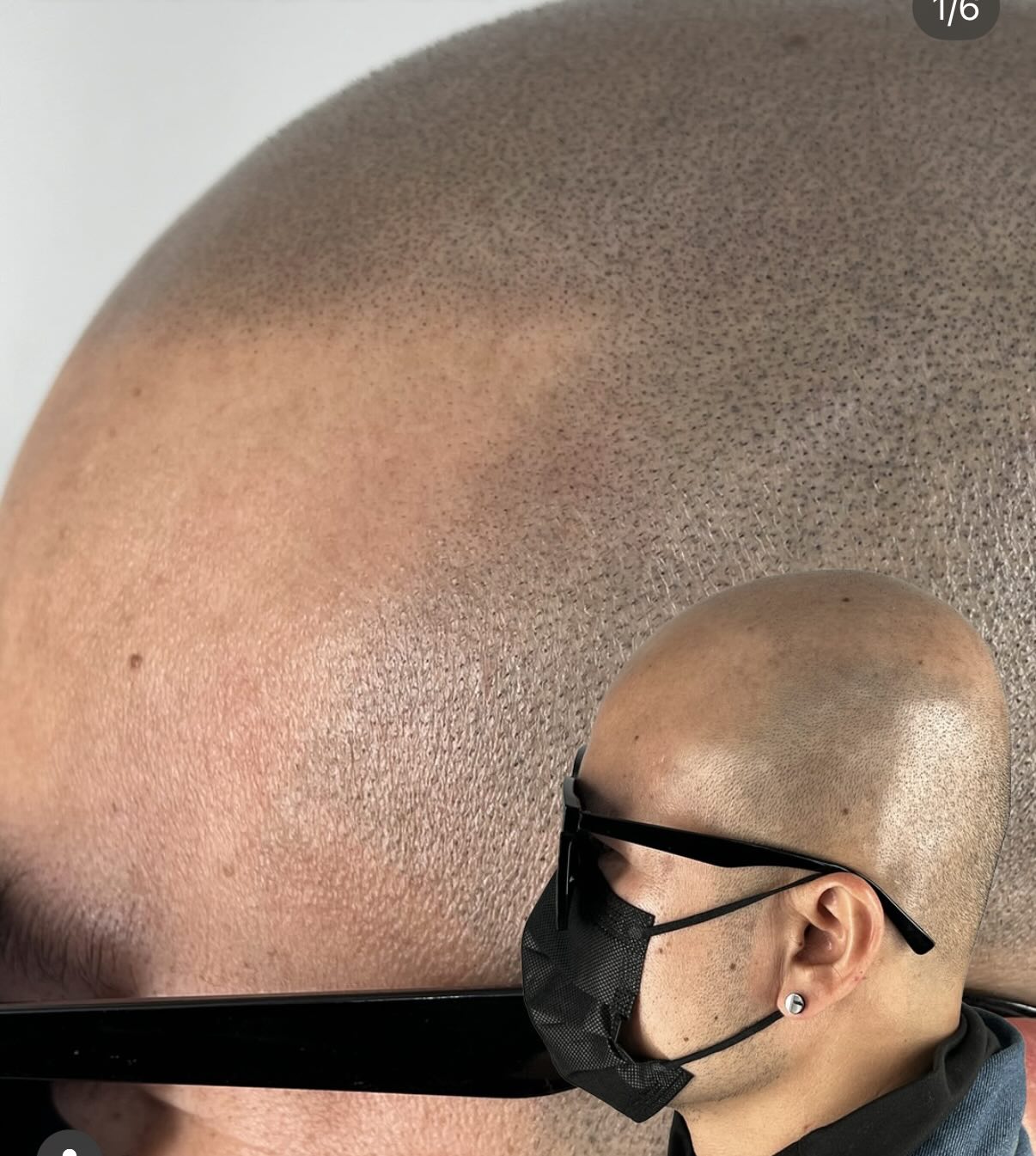 LOOKING FOR 1 MODEL – SMP SERVICE (TOMORROW)
I am looking for 1 model for SMP (Scalp Micropigmentation) service tomorrow.
✔ Suitable for men or women
✔ Hair thinning, bald spots, receding hairline, or shaved head
✔ Special model price / practice session
📩 DM / Inbox me now to secure the spot
(Only 1 model needed)
SMP (Scalp Micropigmentation) is a non-surgical cosmetic procedure that uses specialized pigment to create the appearance of natural hair follicles on the scalp.
🔹 Helps with:
• Baldness or thinning hair
• Receding hairline
• Scalp scars
• Creating a clean shaved-head look
🔹 Benefits:
• Natural-looking results
• No surgery, no downtime
• Long-lasting effect
• Suitable for men & women
✨ Results can be seen immediately after the session.
