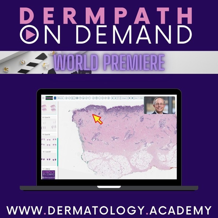 A new UNKNOWNS video has been added to @Clay_Cockerell 's Dermpath On Demand library!
#Dermpath #Dermatology #Residents #DermpathOnDemand #DOD #Dermatopathology