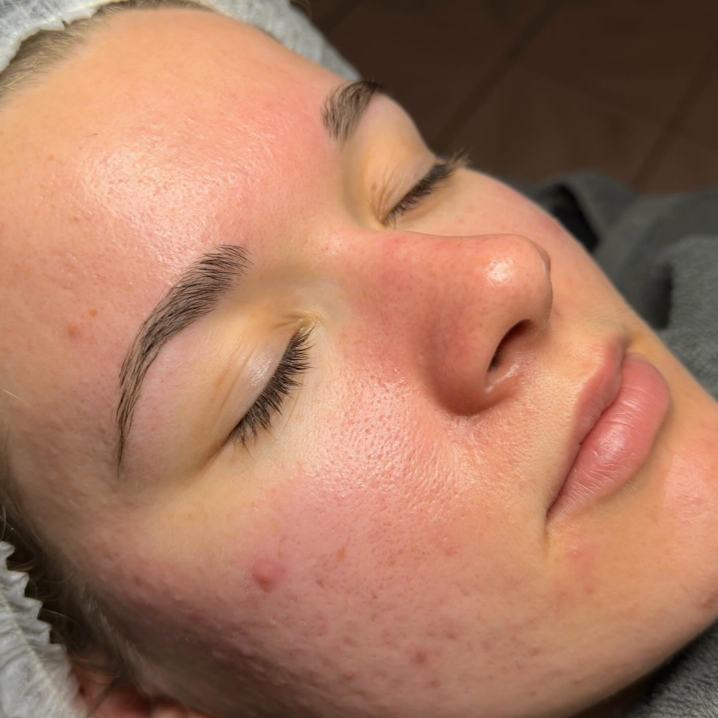 Als jij op zoek bent naar de beste huidverbetering met onmiddellijk én langdurig resultaat, dan is onze dermaplaning jouw ideale behandeling.
Door de huid te behandelen met een chirurgisch mesje verkrijg je heel wat voordelen:
- Alle dode huid wordt verwijderd waardoor producten veel beter inwerken en de huid een prachtige glow krijgt.
- Donshaartjes worden verwijderd, wat zorgt voor een zijdezacht resultaat. Geen paniek: dons komt ook als dons terug ☺️
- De doorbloeding wordt gestimuleerd.
- Fijne lijntjes, rimpels en pigmentvlekken worden verminderd. Je huid ziet er jonger en frisser uit.
- De huidstructuur en -teint wordt geoptimaliseerd.
Om de resultaten te behouden wordt aangeraden om deze behandeling om de 6 weken te herhalen.
Nog niet overtuigd? Hier zie je een na en voor foto van deze favoriet 🥰
Laurence - Natur’elle
📞 0472/37.36.51
💻 www.naturellebylaurence.com