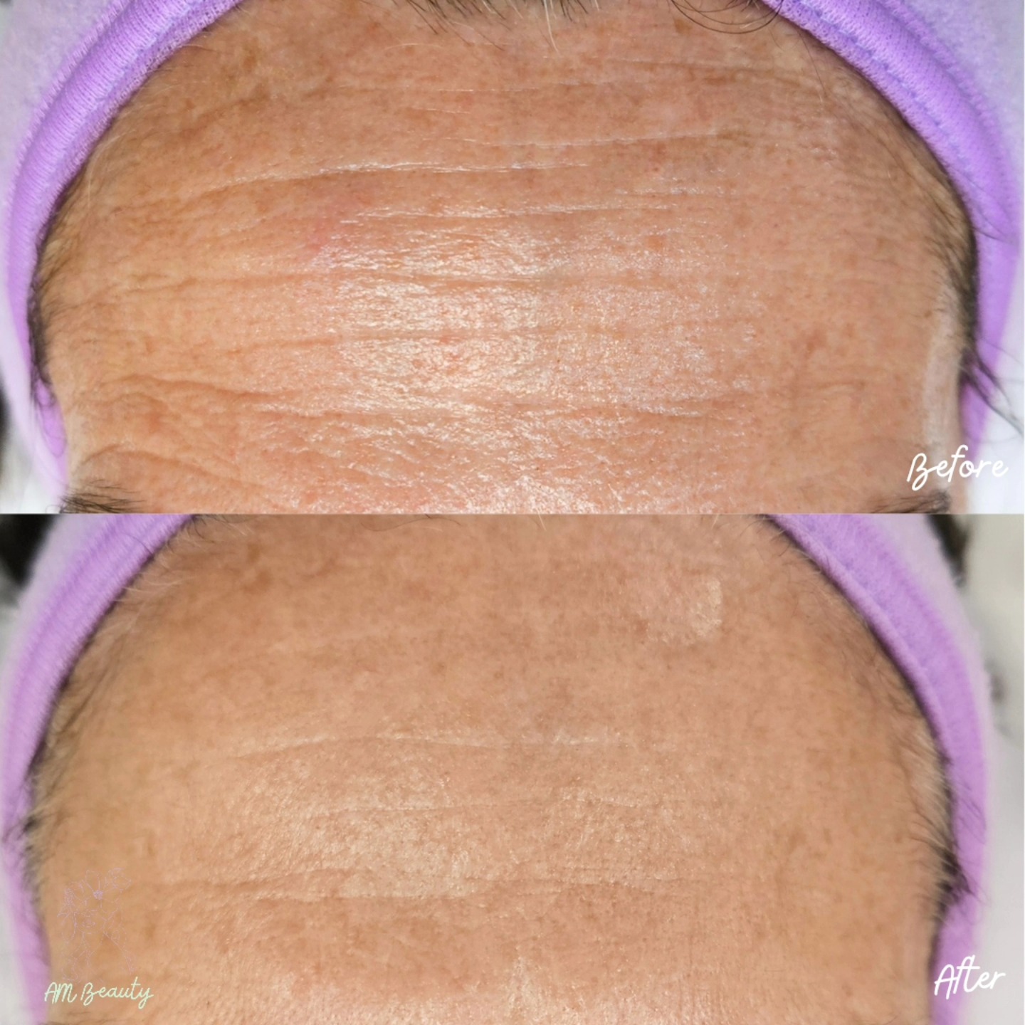 🤯 Can you believe this transformation over 3 months?!
We did alternating PDO AfterGlo and Glo2Facials every 2 weeks to finish just in time for the holidays and now continuing with monthly maintenance treatments 🙌
Not only are the deep expression lines improved without botox but the overall skin quality is so beautiful!
Imagine what we can achieve with professional treatments and a great home skincare routine.
Not sure where to start? Book a virtual consultation to get started on a professional skincare routine ✨️ healthy skin awaits you in 2025.
Located in Kaimuki inside HNL Beautu Co-op
📍3160 Waialae Ave
Honolulu, HI 96816
Link in bio to book or feel free to send a DM!