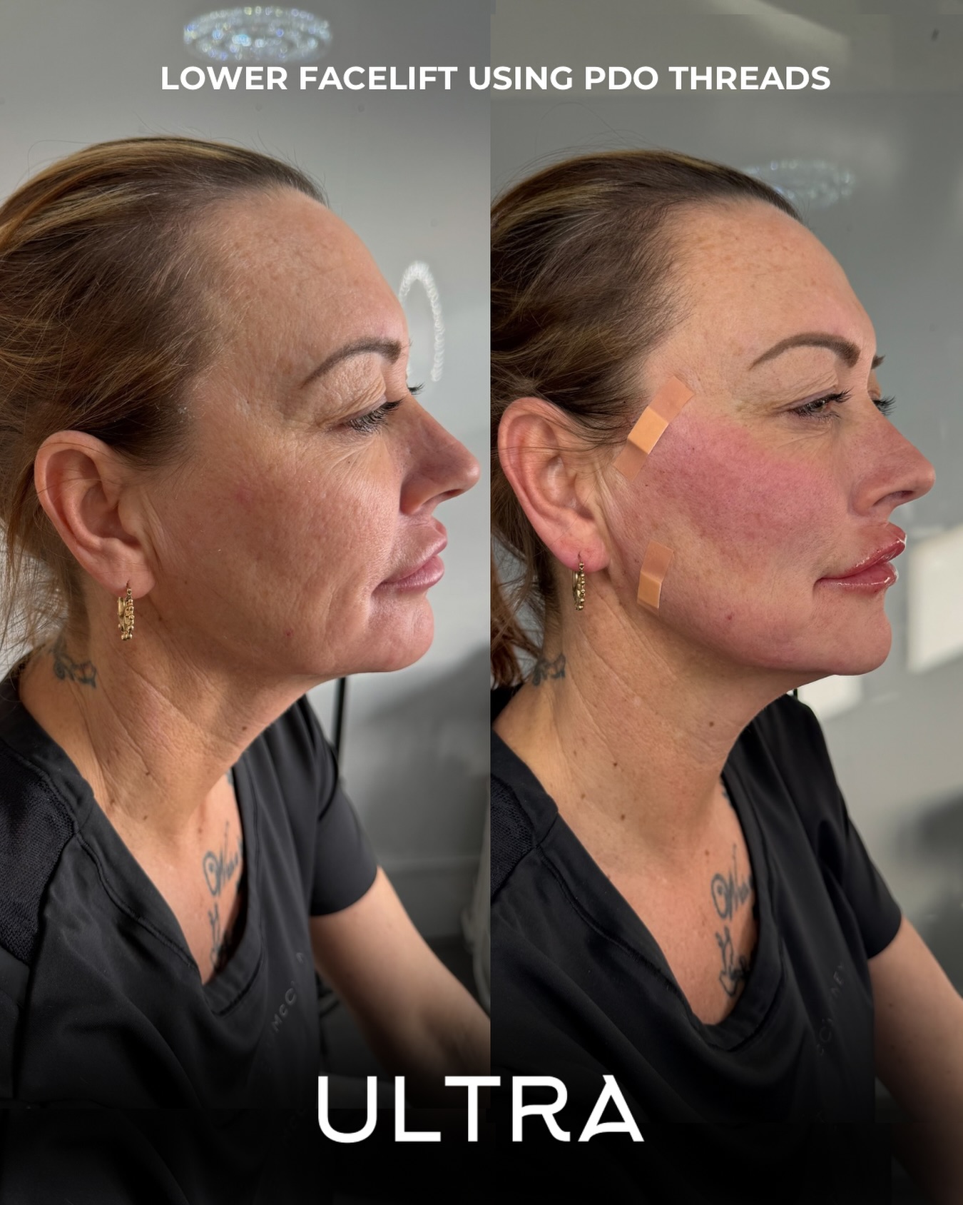 Lower facelift using PDO threads!
PDO threads work by lifting and repositioning the skin while stimulating your own collagen production … improving firmness, definition and skin quality over time.
The best part?
✔️ Performed in a short appointment
✔️ Minimal downtime
✔️ Results continue to improve as collagen builds in the weeks and months after treatment
Perfect for targeting jowls, lower-face sagging and loss of structure without surgery.
📍 Ultra Aesthetics
📩 DM to book a consultation
💉 Advanced, practitioner-led treatments only