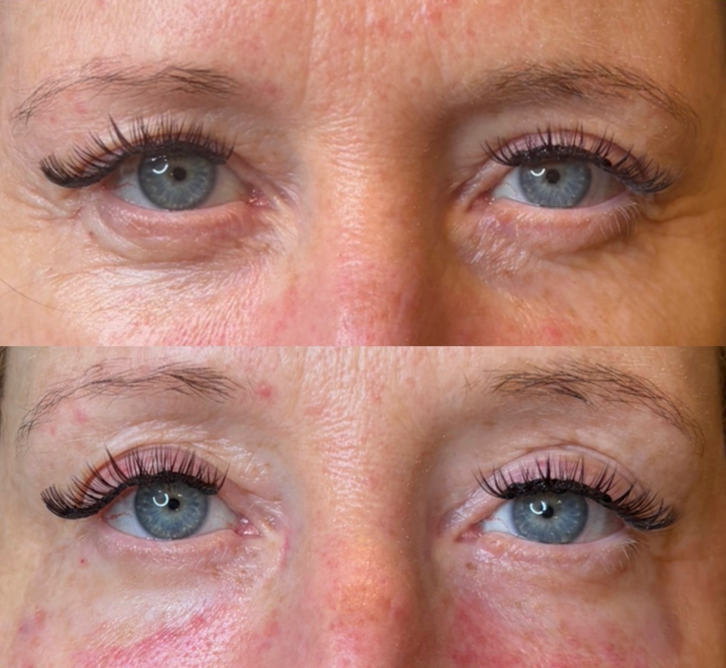 ✨ Testé et approuvé !
Aujourd’hui, je vous partage mon avant/après après avoir testé Juvelook, un biostimulateur utilisé dans la zone des cernes.
Il s’agit d’un produit à base d’acide polylactique (PLA) et d’acide hyaluronique, conçu pour stimuler progressivement la production de collagène. L’objectif n’est pas de “remplir” comme un filler classique, mais d’améliorer la qualité de la peau, la texture et la fermeté au fil des semaines.