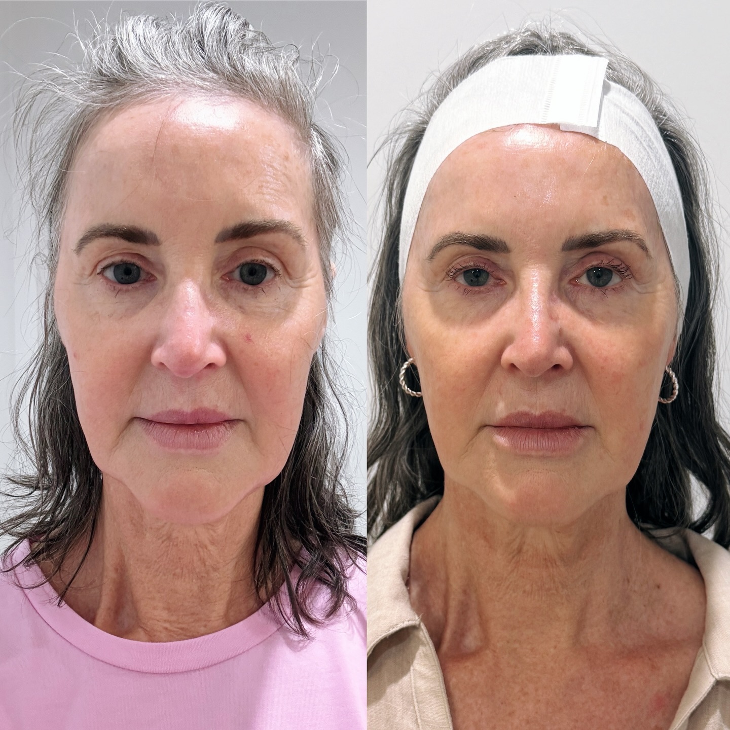 What can we say! Results like this validate everything we do here at Ogee.
Sharon had 6 Emface sessions this time last year to balance her eyebrows and to lift her lower face and in particular minimise her jowls.
These results are 12 months after her initial session.
She will have some maintenance sessions soon and we are excited to see more progress!
🧡💛🧡
Reminder: Every journey is unique — results + recovery will vary. Information here is general, not medical advice. Some treatments can only be explained in person.
#OgeeFacialRejuvenation
#nonsurgicalfacelift #jowllift #lowerfacerejuvenation
#emface
@positivelyforeveryoung