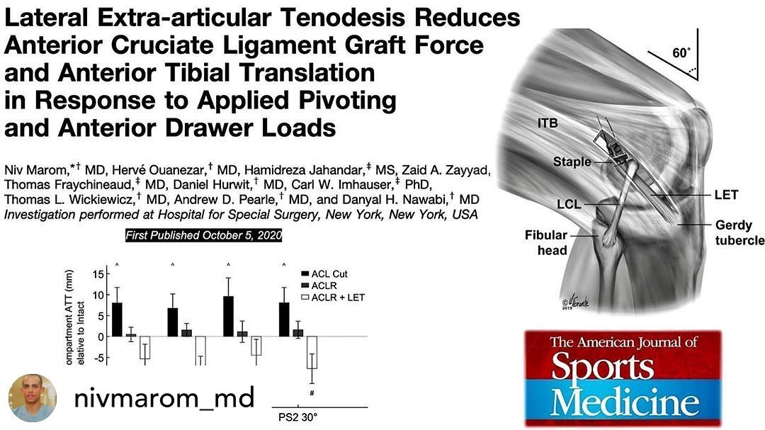 New Study about Knee ACL Reconstruction and LET!
#santigroup #hss #sportsmedicine #dxbone #kneesurgery #aclreconstruction