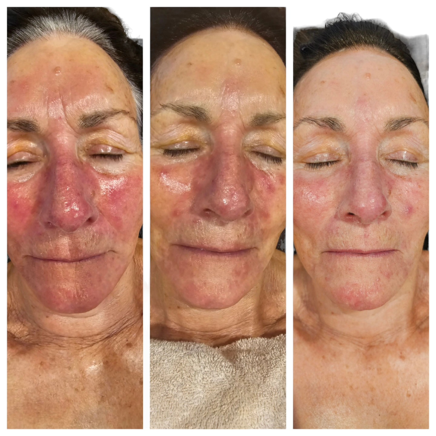Rosecea treatment from using the mask daily.
#rosecea #ledmask #ledtreatment
