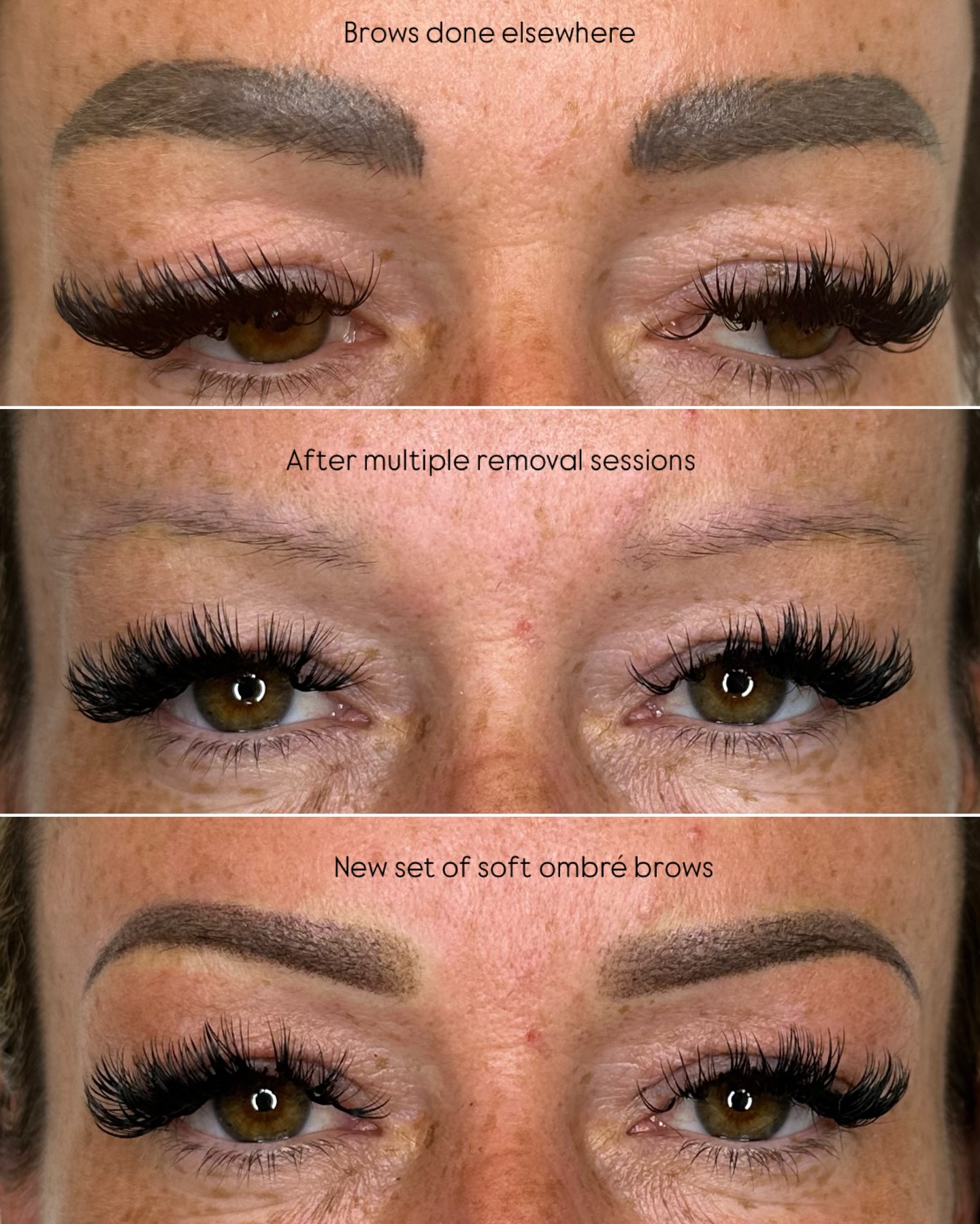 REMOVE & REDO
My lovely client came to me wanting new brows as she was unhappy with previous permanent makeup done elsewhere. Unfortunately this wasn’t possible straight away due to the high level of pigment saturation already present in the skin. Adding more pigment at that stage would have led to poor retention, colour distortion and unnecessary skin trauma.
It was time to begin her remove and redo journey.
This kind of transformation takes time and after 3 saline removals, 2 laser sessions, and a whole lot of patience we finally achieved a clean enough canvas to create the beautiful brows she deserved.
⬅️ Swipe to see my client’s journey to beautiful brows
If you’re unhappy with your brows or thinking about removal and redo please get in touch. I’d love to help you 😊
𝐓𝐎 𝐁𝐎𝐎𝐊 ✨
𝐅𝐑𝐄𝐄 Consultations
📞 07939822419
💬 DM me
📧 luxebrowssurrey@gmail.com
📍Leatherhead, Surrey