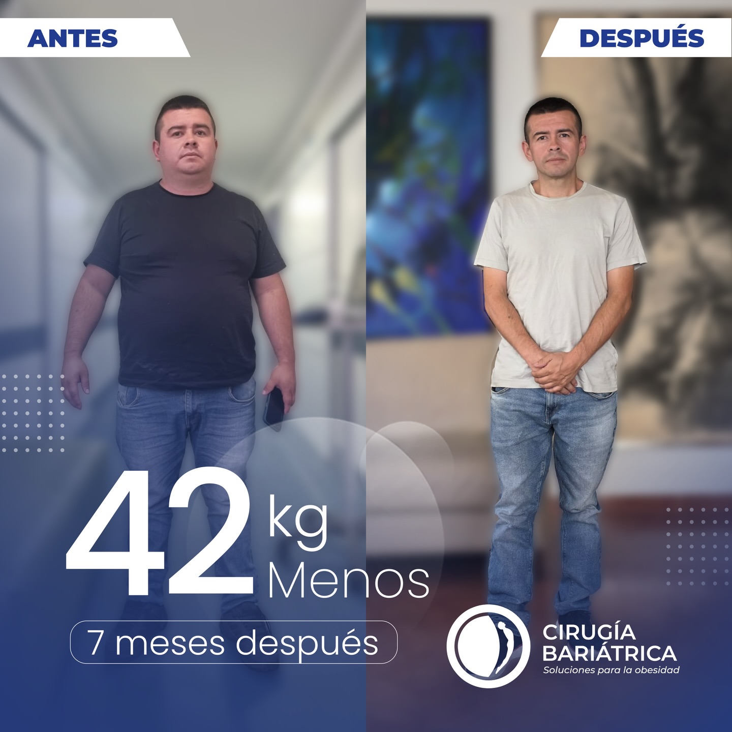 -42 kg en 7 meses 🔥
Un cambio que va más allá de lo físico: es salud, disciplina y una nueva oportunidad para vivir mejor. 🙌
Gracias a la cirugía bariátrica y al acompañamiento del Dr. Bolaños y su equipo, este paciente logró alcanzar sus objetivos y transformar su calidad de vida con el respaldo de gran conocimiento médico, tecnología de última generación y manos expertas. 🏥✨
Cuando la decisión es por tu bienestar… los resultados hablan solos. ✅💙
-92.6 lbs in 7 months 🔥
A transformation that goes beyond appearance — it’s about health, confidence, and a whole new quality of life. 🙌✨
Thanks to bariatric surgery and the dedicated care of Dr. Bolaños and his team, this patient achieved their goals with the support of medical expertise, advanced technology, and the best hands in the field. 🏥💙
When you choose your well-being… the results speak for themselves. ✅
#bariatricsurgery #bariatrica #bajardepeso #weightlosssurgery #health