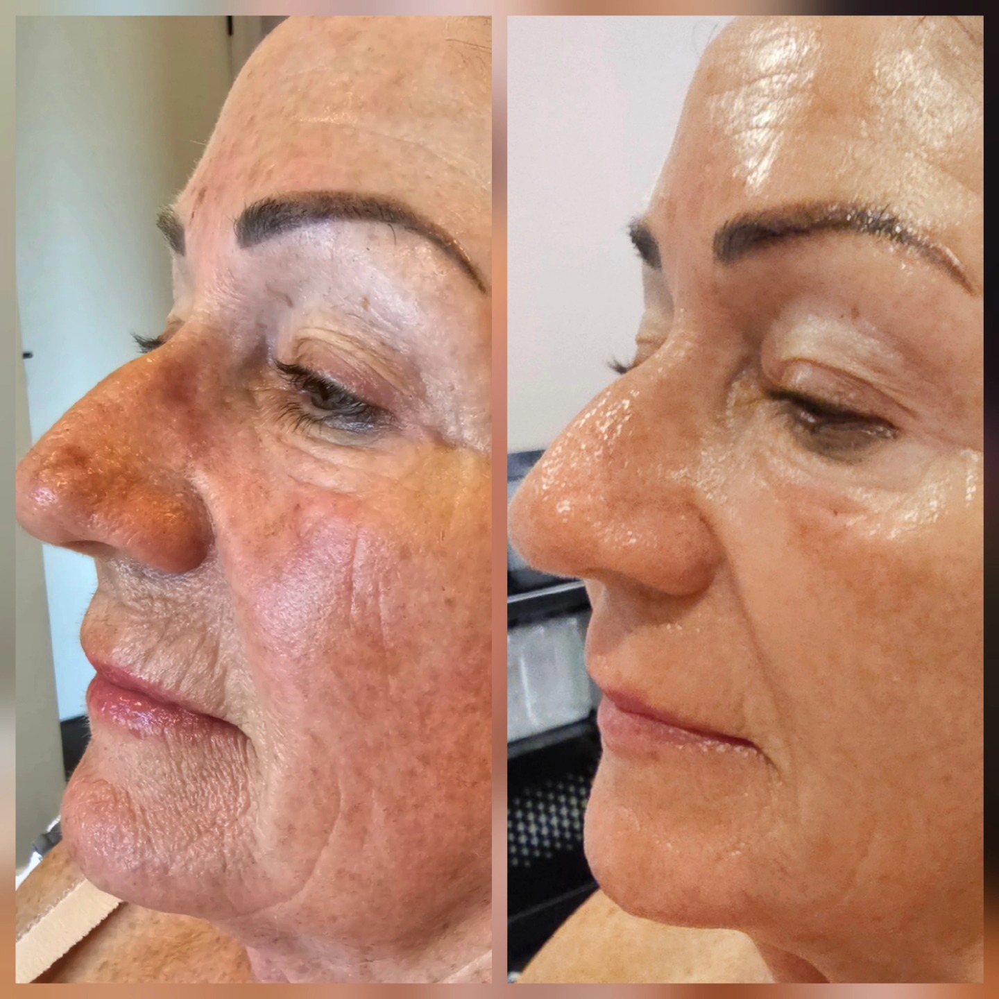 In salon treatments combined with LED every night before she applies her skincare
Also uses THE MASK on her hands after IPL
#ledlights #ledtreatment #ledmask #redlight #yellowlight