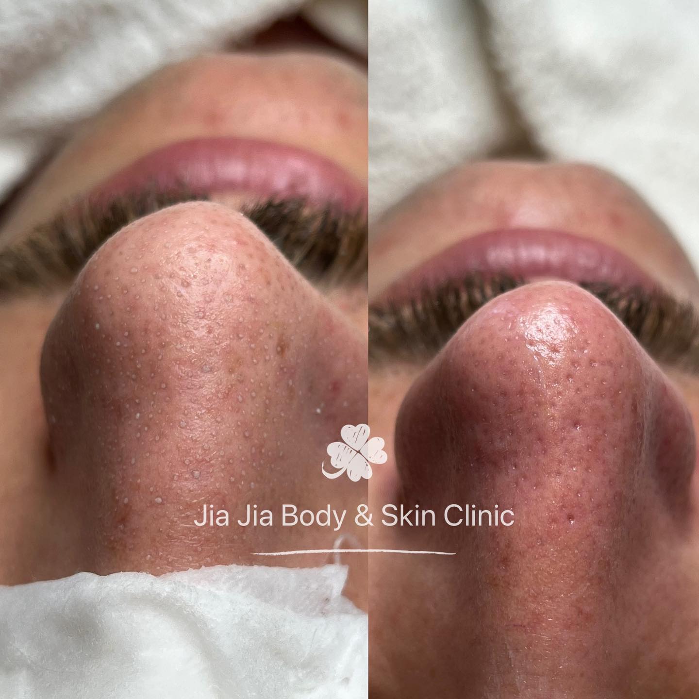 If you’re interested in facial extractions, try Jia Jia ‘s skin treatments once a month for best results.
#clearskin #facial #extraction #skincareroutine