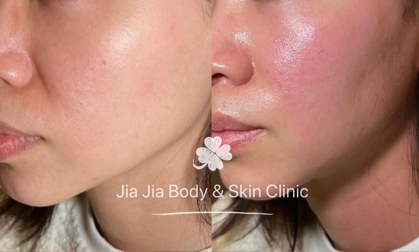 Immediately result after Skin tightening treatment.
Donāt waitļ¼Just do Itļ¼
No painļ¼No downtimeļ¼highly recommendļ¼