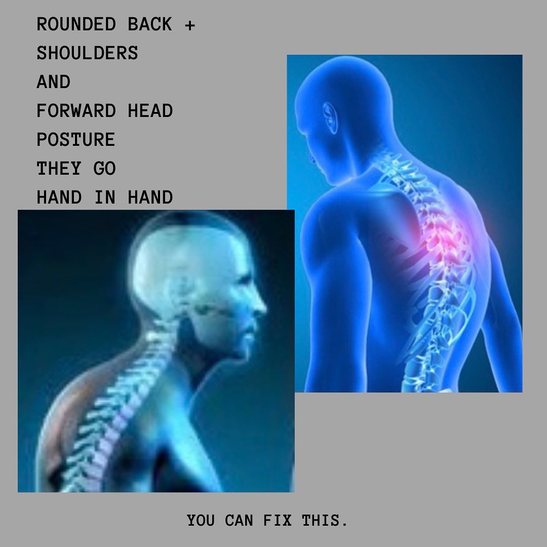 So you’ve done some postural checks and recognize that you have some issues. Quite possibly forward head posture and rounded shoulders and back. They are best buddies.
Let’s work on some fixes. I’ve provided a couple of videos for some guidance. This took tremendous courage let me tell you...and then didn’t work! 🙄🤦♀️🤣
For the forward head posture the first step is getting familiar with a normal head position and what that feels like to you. I often use the analogy of a string attached to the crown of the head gently tugging you upward - lengthening the neck (cervical spine) and ramping the head back. Keep the chin down.
People think good posture is pulling the shoulders back which doesn’t really change anything and leads to other things such as the ribcage thrusting out, the head tilting back and the chin jutting up.
To open up the rounded shoulders I use the image of a waiter with a tray. Flip the forearms up as if to receive a tray, elbows at 90 degrees by your side. When you do this take note of the muscles under the armpits and your lats engaging. Imagine sliding your shoulder blades down into your back pockets. Voila your shoulders are now in a much better position posturally and your back muscles are working.
Changing your posture requires paying attention to yourself and making the necessary corrections hundreds of times before it becomes your default position.
The learning curve goes something like this
Unconscious incompetence - you are unaware of your habits and postions
Consciously incompetent - aware but making no changes
Consciously competent - aware and making the necessary changes - this is a 24/7 job
And finally
Unconciously competent - your new and improved position becomes naturally and easily to you.
*
*
*
*
*
*
#workingfromhome
#worklife
#lifework
#balance
#goodpostureisthenewsexy
#thesearechallengingtimes
#you’vegotthis
#setatimer
#goodpractice
#buildingyourawarenessforselfhealing