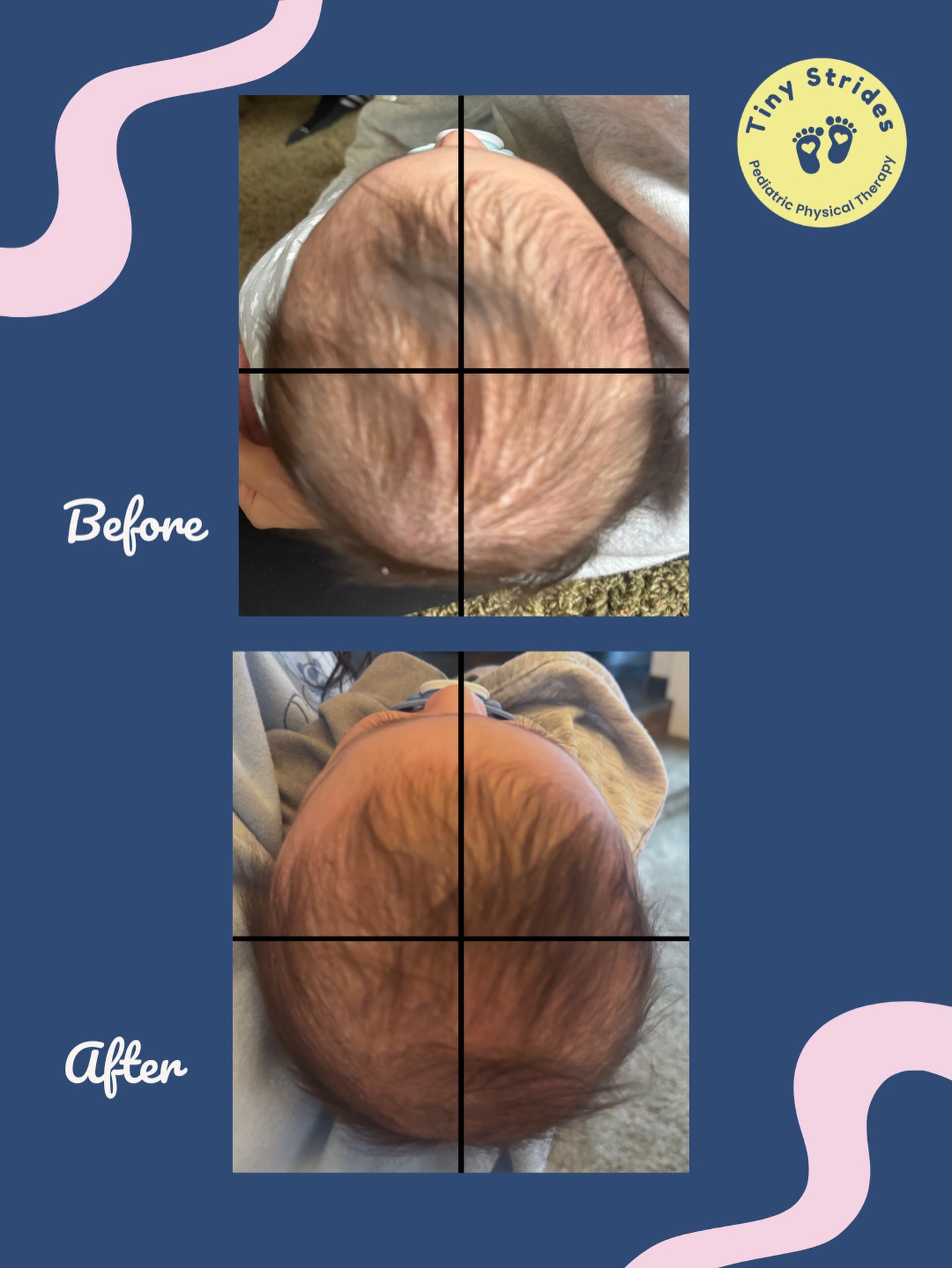 When I started seeing this sweet client, he had moderate plagiocephaly affecting the left side. After 4 sessions, his head shape improved significantly. Parents and his pediatrician are both so happy he has made such good progress and is avoiding a helmet!
These photos were taken 2 weeks apart (sessions 2 and 4).