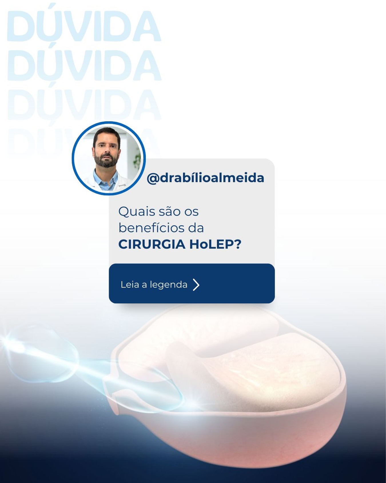 A HoLEP (Enucleação Prostática com Laser de Holmium) é uma das técnicas mais modernas e eficazes para o tratamento da hiperplasia prostática benigna (HPB) — o aumento benigno da próstata.
✅ Principais benefícios da HoLEP:
• Procedimento minimamente invasivo
• Pode tratar próstatas de qualquer tamanho
• Menor sangramento, ideal para pacientes em uso de anticoagulantes
• Recuperação mais rápida
• Menor tempo de internação hospitalar
• Baixo risco de necessidade de nova cirurgia no futuro
• Melhora significativa do jato urinário e dos sintomas urinários
🔬 O laser remove o tecido que obstrui a uretra, preservando as estruturas importantes e proporcionando um resultado duradouro e seguro.
👨⚕️ A escolha do tratamento deve ser individualizada, após avaliação com um urologista.
📲 Agende sua consulta e saiba se a HoLEP é indicada para o seu caso.
#Urologia #HoLEP #Próstata #HPB #SaúdeDoHomem