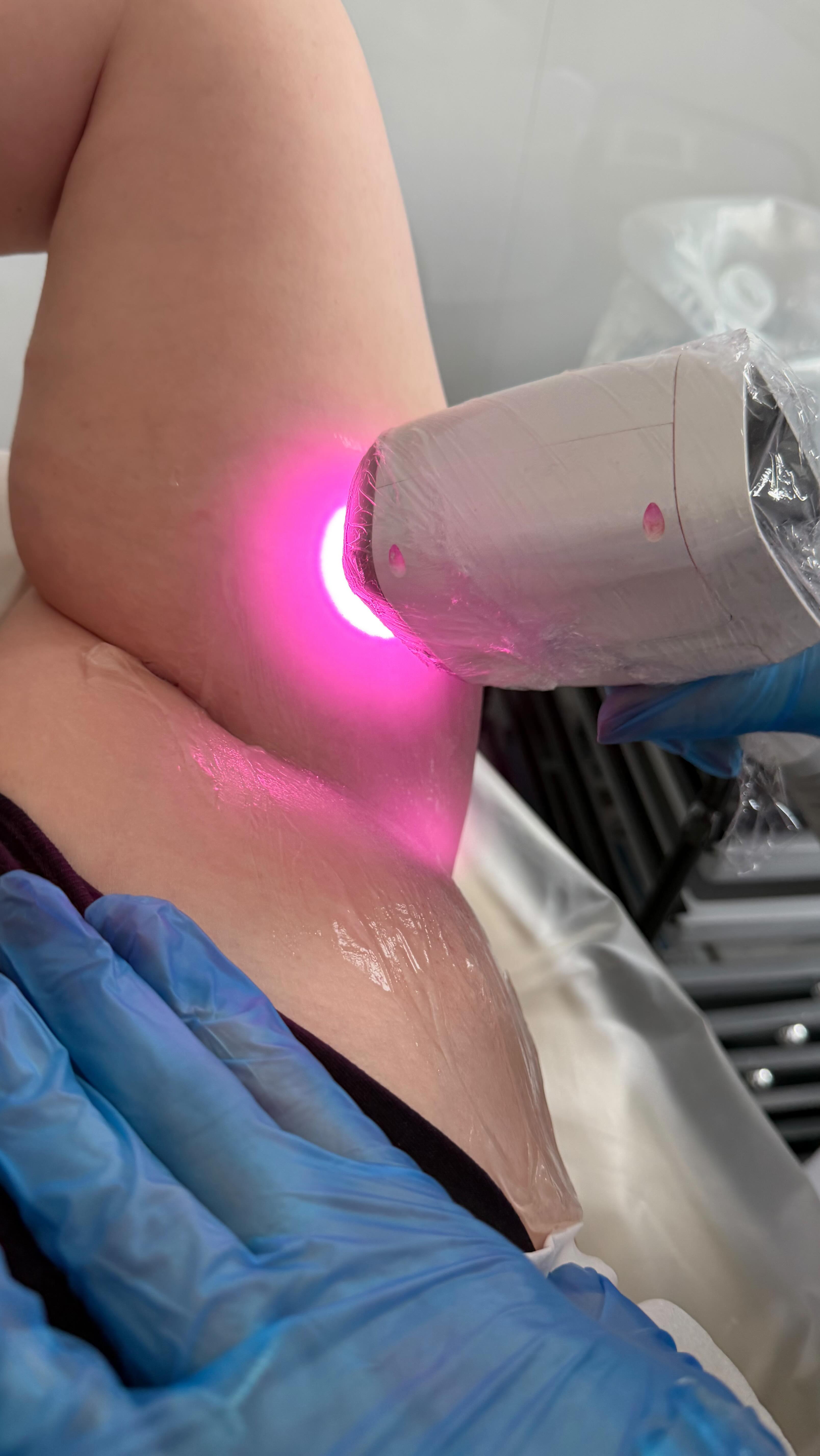 Hair we’re not taking into 2026 🚫
Any form… apart from thick locks on our heads.
Now is the time to get laser with summer lurking round the corner, say bye to razer bumps and stubble and hello to smoother skin, and way less effort.
⚡️Full leg
⚡️Brazilian
⚡️Bum
⚡️Under Arm
6 Sessions £349
Strong medical grade laser.
📩 DM to get started
💰 Klarna can be used