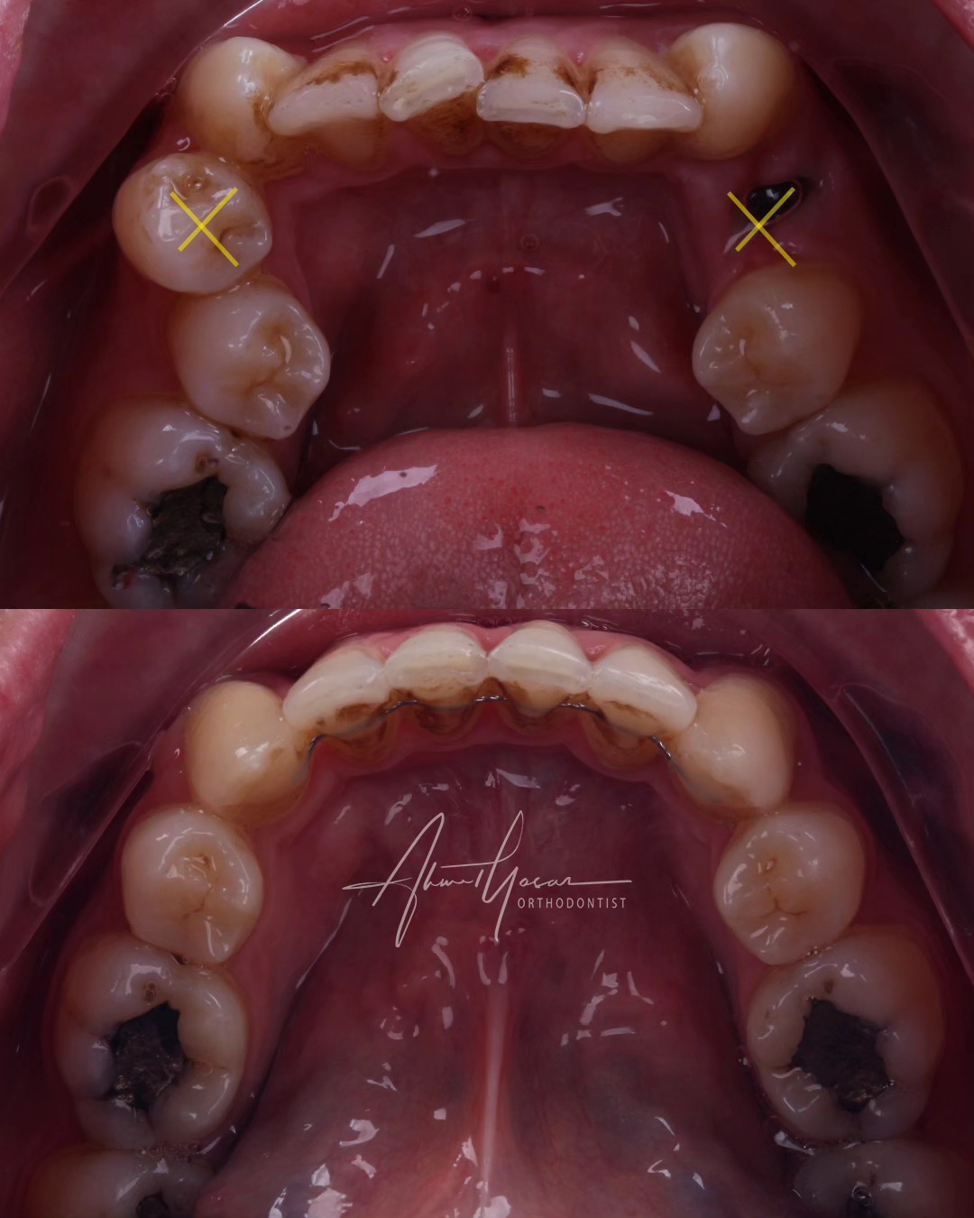 Our clinic is authorized by the Ministry of Health of the Republic of Türkiye for International Health Tourism. All patients have been informed and have provided consent for the use of their photographs on our social media platforms. All content shared on social media is intended to inform patients about procedures and should not be perceived as advertising. Outcomes of any surgical or interventional treatment may vary from person to person. It is recommended to consult your physician for detailed information before undergoing any procedure.
.
.
.
#ortodonti #ortodontist #bursa #fsm #bursaortodonti #bursaortodontist #bursaortodontiuzmanı #orthodontics #braces #teltedavisi #invisalign #invisalignbursa #şeffafplak #lingualortodonti #lingualorthodontics #dişteli #ortholove #selfligating #kapaklıbraket #gülüştasarımı #dent #dentistry #art #picoftheday #photography #estetik #dentalart #ahmetyasar #drahmetyasar