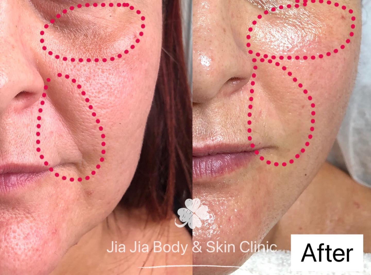 5-day intensive care of skin treatment, you will get firmer, brighter and smoother skin.
We using all-natural ingredients to against your aging!!!
šæVegan friendly šæ
#jiajiabodyandskinclinic
#naturalskincare #herbalmedicine
#veganskincare
#skintightening