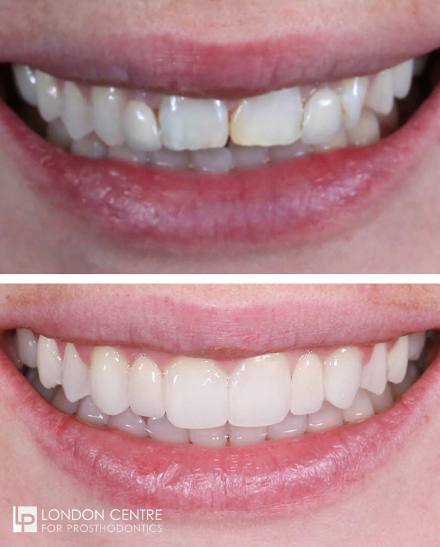 Patients come to see us with a whole host of problems. The solution may be simple, like replacing a filling but we also successfully treat patients with complex dental problems.
This patient was unhappy with her smile. She did not like the alignment and lack of uniformity with the shapes and contours of her teeth. Her upper lateral incisor teeth never formed and they were being replaced with poorly shaped and positioned adhesive bridges that made her smile even worse. She also has a huge discrepancy between the positions of her upper and lower teeth which we call increased overjet.
After detailed multidisciplinary planning, @dremmalaing set up her case with excellent orthodontic treatment. @kavitnshahcompleted the treatment and created the beautiful smile she was looking for with Tooth whitening using @enlightensmiles, subtle composite bonding using @gcunitedkingdom Essensia multilayered composite and replacement of the missing lateral incisors with ceramic adhesive bridges expertly crafted by @richart.ds
Complex cases need collaboration and team work. We work with the best to make sure you get the best results 👏
Get in touch with our team to book your appointment - we look forward to seeing you soon!
The London Centre For Prosthodontics
29 Weymouth Street
London, W1G 7DB
020 7637 4518
info@londonprosthodontics.com
Monday - Friday: 7:30am - 4:30pm
#SmileMakeover #EmergencyDentistLondon #LondonDentalClinic #SmileTransformation #CosmeticDentistLondon