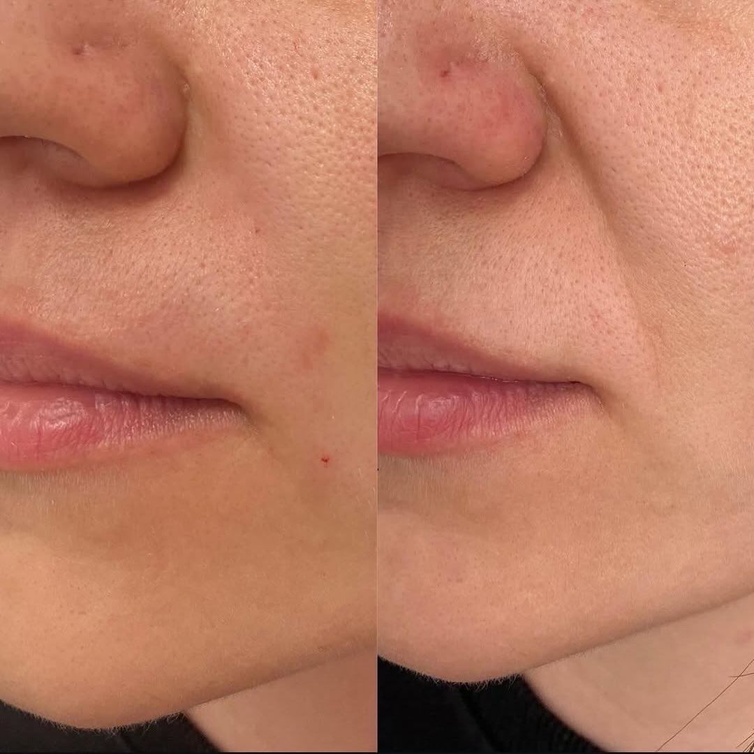 Sanfte Korrektur der Nasolabialfalte💉
#Nasolabialfalten
#deincosmetologist
#Faltenbehandlung
#Faltenunterspritzung
#Hyaluron