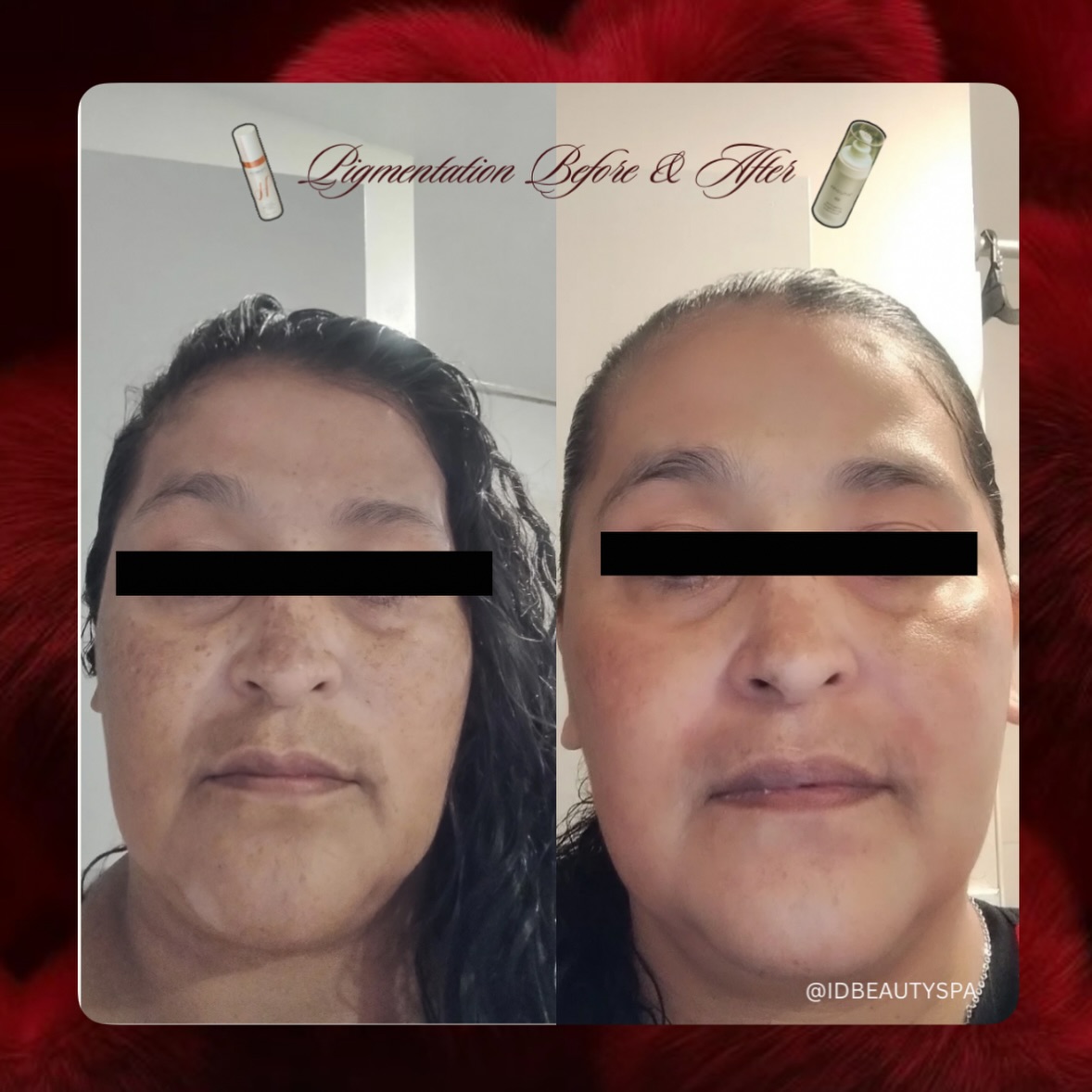 The Power of a Brightening Cream ✨
This transformation reflects a 6–7 month period, beginning with Hydrinity Vivid Brightening and later transitioning to Epicutis Arctigenin.
After we initially started her on professional homecare, the client began working with a dermatologist and was prescribed a medication that unfortunately compromised her skin barrier. Her skin became extremely sensitized—so much so that even water caused burning and flare-ups, issues she had never experienced before.
At that point, our focus shifted to barrier repair and skin recovery. We took a patient, corrective approach before reintroducing brightening treatments. Allowing the skin to heal first was essential to achieving safe, long-term results.
The outcome speaks for itself.
If you’re ready to work toward healthy, radiant skin with a customized plan, schedule your visit today:
Idbeautyspa.com 🔗