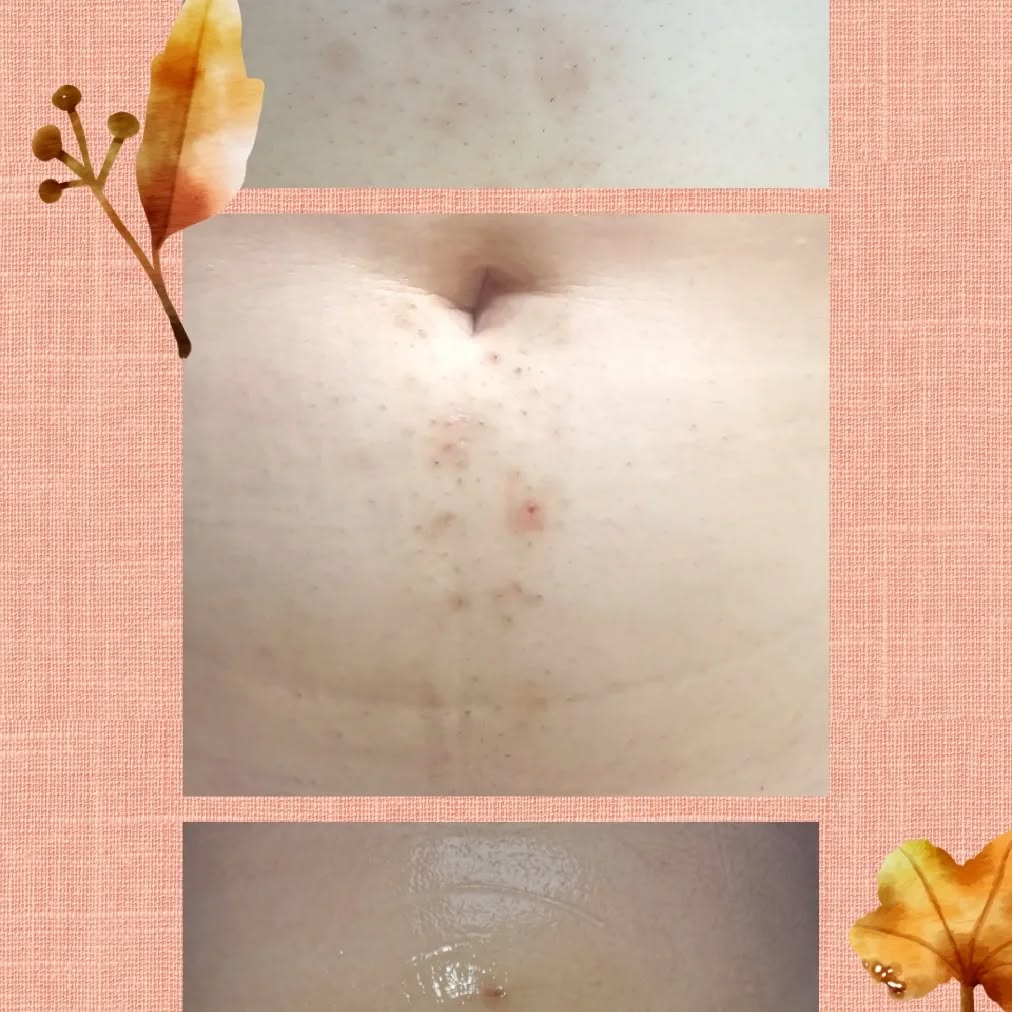 #laserhairremoval
#tummyhair
#spotsgone