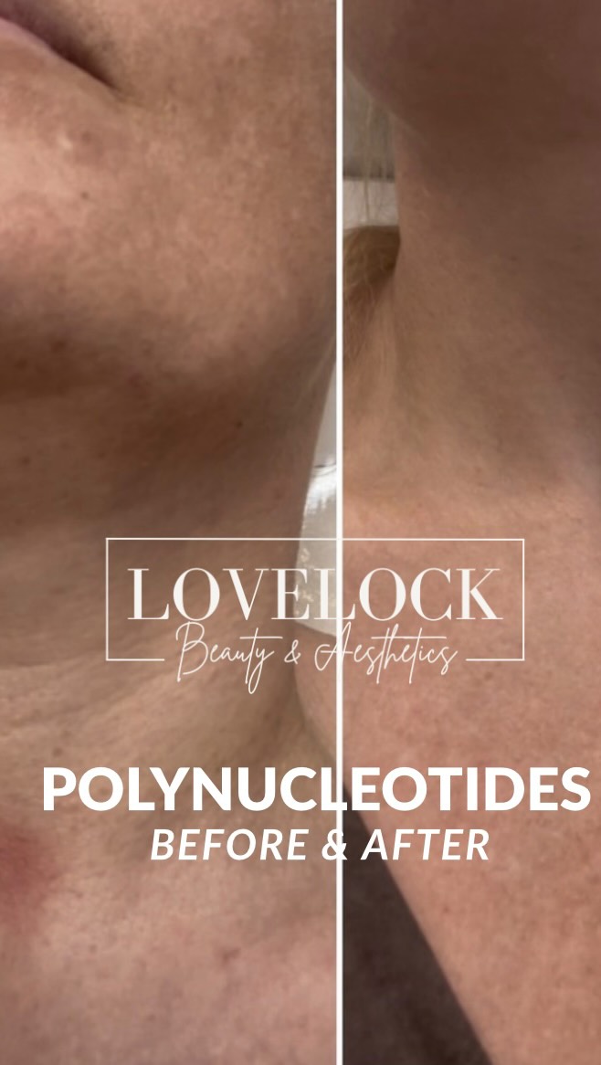 Polynucleotides are the ultimate skin rejuvenation booster — hydrate, plump + repair from the inside out.
They stimulate collagen, improve texture, brighten the skin and help reduce lines, pigmentation & inflammation.
Think fresh, healthy, glowy skin that continues to improve long after treatment.
Just look at these amazing results on my client after 3 treatments.
#trowbridge #westbury #hilperton #frome #warminster