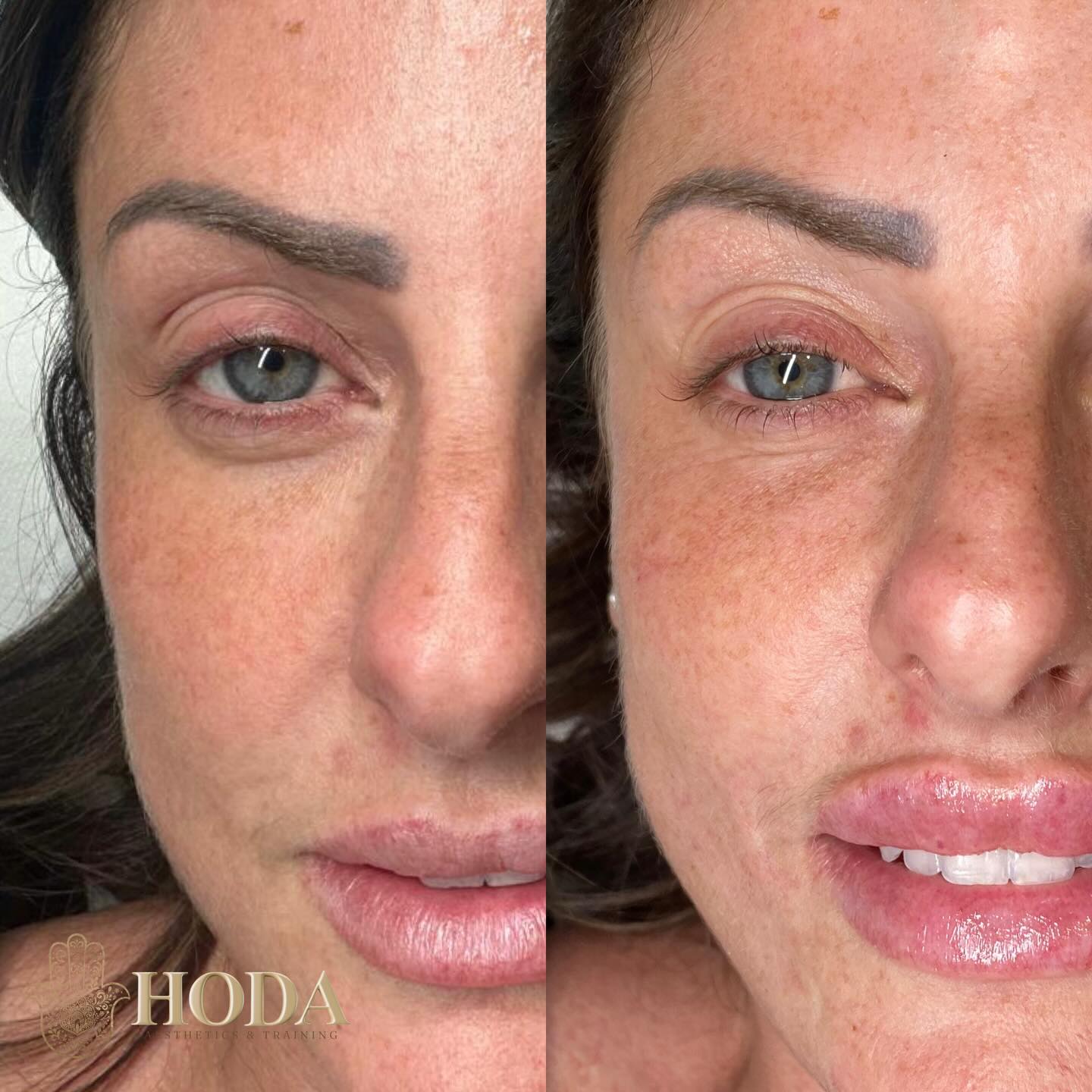 โจ Before & After โจ
This beautiful client was treated with tear trough filler to soften under-eye hollows and reduce a tired appearance, and lip filler to enhance shape, hydration, and natural volume.
The goal: refreshed, balanced, and natural โ never overdone.
Subtle treatment. Beautiful results.
๐ฒ DM book with Hoda
๐ฉ๐ผโโ๏ธ Nurse Led-Aesthetic Clinic
๐ Bournemouth, Dorset
#undereyefiller #facialbalancing #aestheticmedicine #lipfillerbournemouth #teartroughfillers