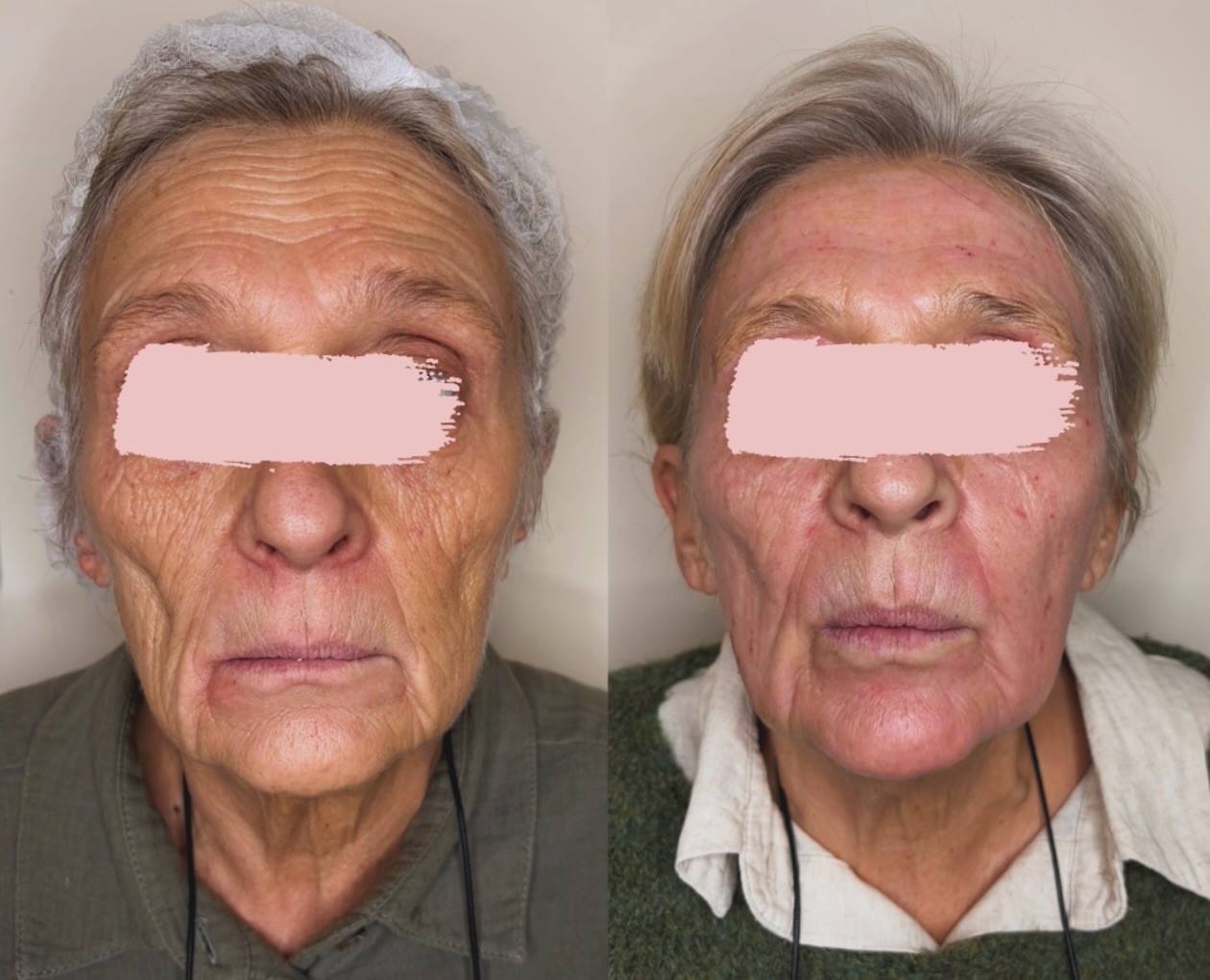 ✨ Avant / Après – Laser CO₂ UltraPulse (J+10)
Aujourd’hui je vous partage le résultat à 10 jours d’un traitement au laser CO₂ fractionné UltraPulse (Lumenis) sur l’ensemble du visage.
Le laser CO₂ UltraPulse c’est une technologie de resurfacing qui crée de micro-colonnes de chaleur contrôlée dans la peau. L’objectif : stimuler la régénération cutanée, lisser la texture, améliorer l’aspect des rides et des irrégularités, et favoriser une peau plus homogène au fil du temps.
⏳ À J+10, c’est encore en évolution :
La peau peut rester rouge, rosée ou sensible, ce qui est tout à fait normal à ce stade. Les résultats se construisent progressivement dans les semaines et mois qui suivent, le temps que la peau se renouvelle.
✨ Cette patiente a eu un full face, et même si la cicatrisation continue, on peut déjà observer les premiers changements de texture.