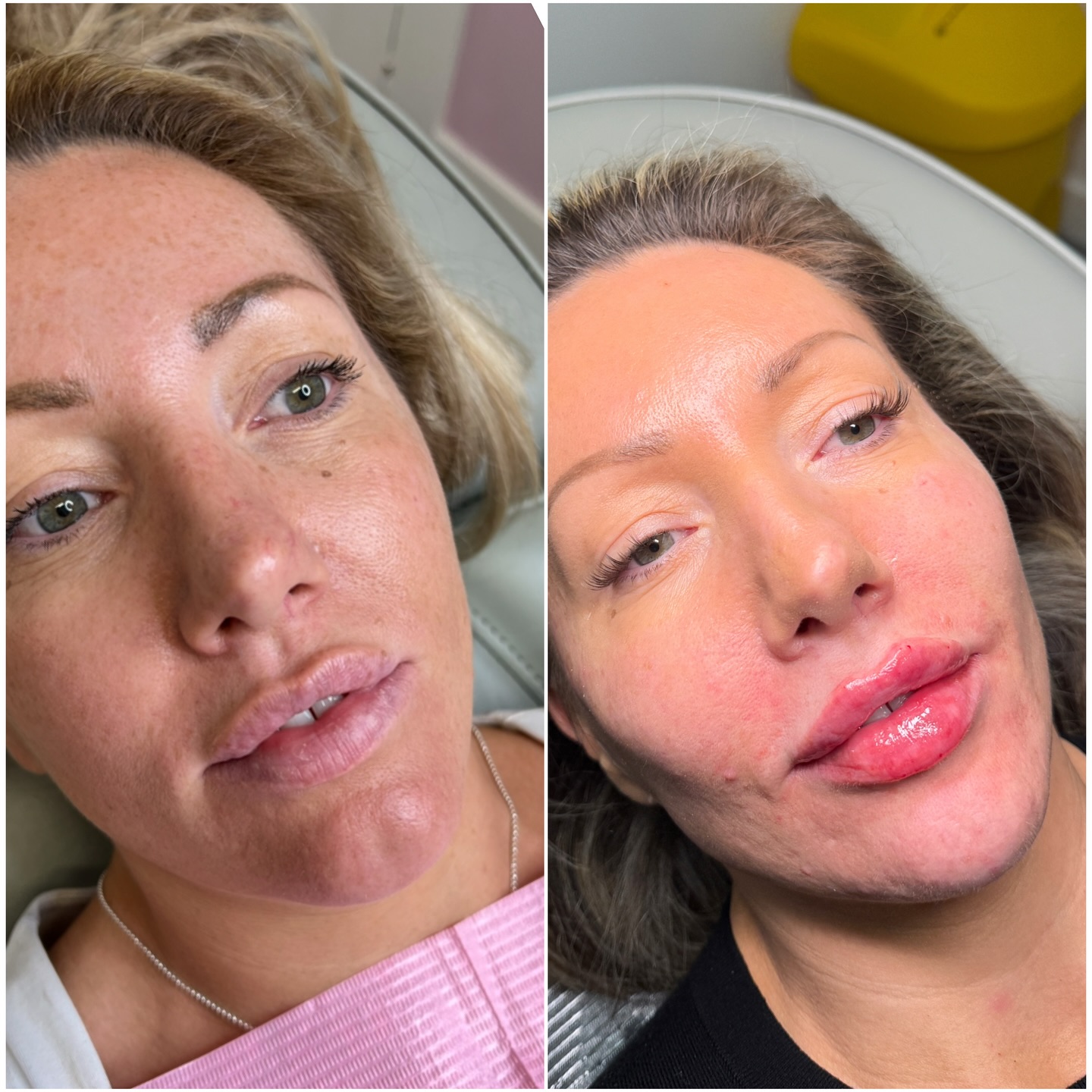 How it started vs how it’s going ✨🪄🧚🏼
These photos were taken 3 years apart. As you can see the lips have been completely reshaped and defined, the chin dip has been undetectably filled and we have added contour to the cheeks.
It’s SOOO important to find a practitioner who understands your goals and works with you to manage your beauty as you age 💕
Next contour package spaces:
Barnham - 13th Feb
Chichester - 4th March
📔Book via link in bio or DM for cancellations list