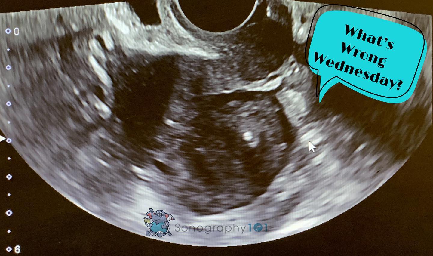 For this week, there isn’t something necessarily “wrong” but there’s definitely something DIFFERENT! 😁 can you tell what it is ?
Image by one of our girls @snranger ❤️ ANSWER:, Retroflexed Uterus