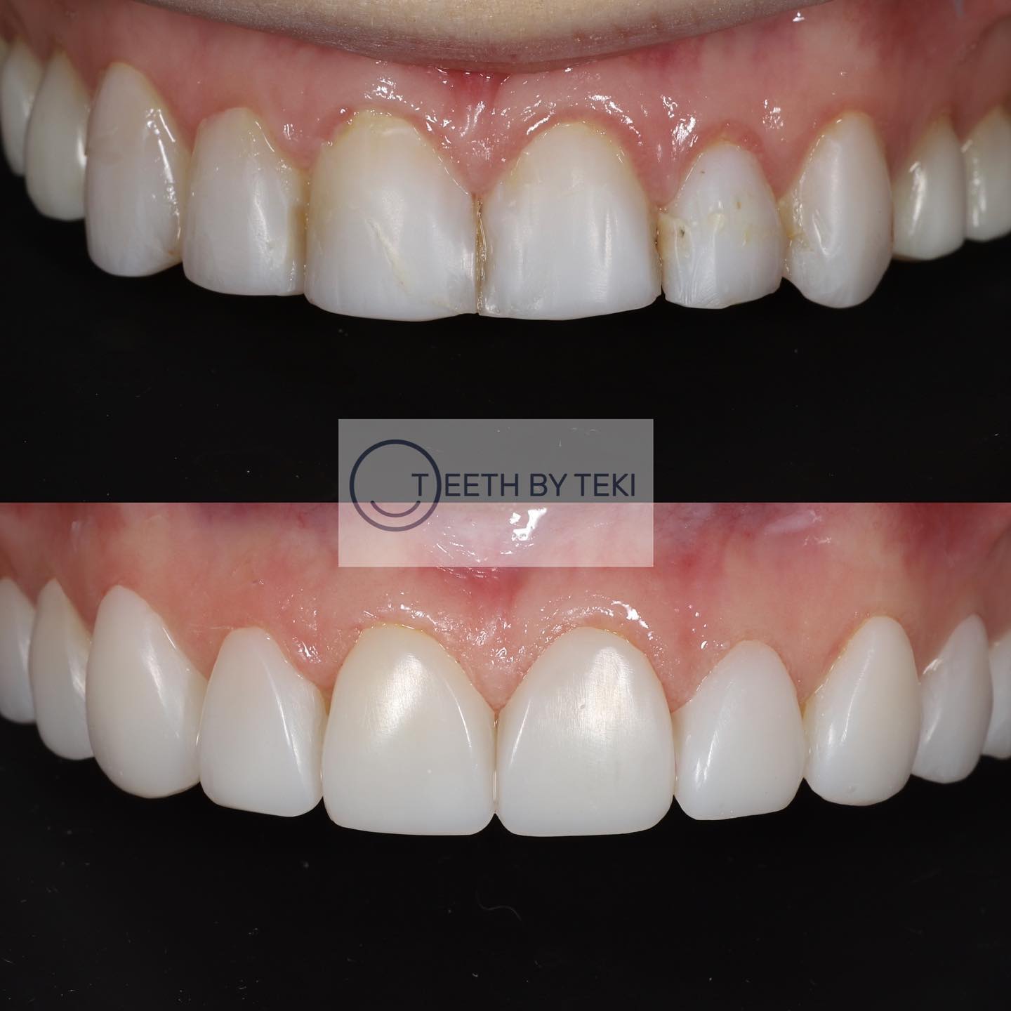 CORRECTIVE WORK 💙
.
.
Corrective work is more difficult, takes longer and costs more 😅
.
.
Take your time making sure the dentist you see is experienced at what they do. These composites had failed after only 6 months 😢
.
.
The old ones removed and replaced 💙
.
.
#teethbyteki #compositebonding