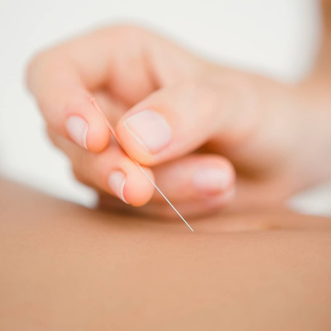 ✨Acupuncture for Fertility✨
Research shows it may increase the chances of conception from IVF treatments.
The teeny-tiny needles may help by:
👉Encouraging blood flow to the pelvic region – Better blood flow, delivering fresh oxygen and nutrients to the uterus and ovaries, may help with the implantation of an embryo🩸
👉Stress Reduction - The insertion of needles at specific points may help calm an overactive nervous system, but I also think forcing someone to lie still in a quiet, dim room might have something to do with its relaxing effect 😆
We know stress has a negative impact on both male and female fertility, and of course trying to get pregnant in itself can be an incredibly stressful journey. We can’t eliminate all sources of stress in our lives, but the more tools and support we have to manage it, the better we can mitigate the negative impact it has on our fertility (and overall health) 🙌
Acupuncture can also be helpful even if you're not going through IVF, for the same above reasons. Treatments throughout your cycle can help support ovulation, a healthy endometrium, and basically what your hormones should be doing naturally to help with chances of conception 🐣
Have you tried acupuncture before? Feel free to reach out for more info, and to see if acupuncture might be right for you! 😊
#naturopath #naturalmedicine #fertility #ivf #acupuncture #fertilityacupuncture #naturalfertility #cycletracking #ovulation #integrativemedicine #stressmanagement #womenshealth #hormonalhealth #hormonebalance #hamont #grimsbyontario