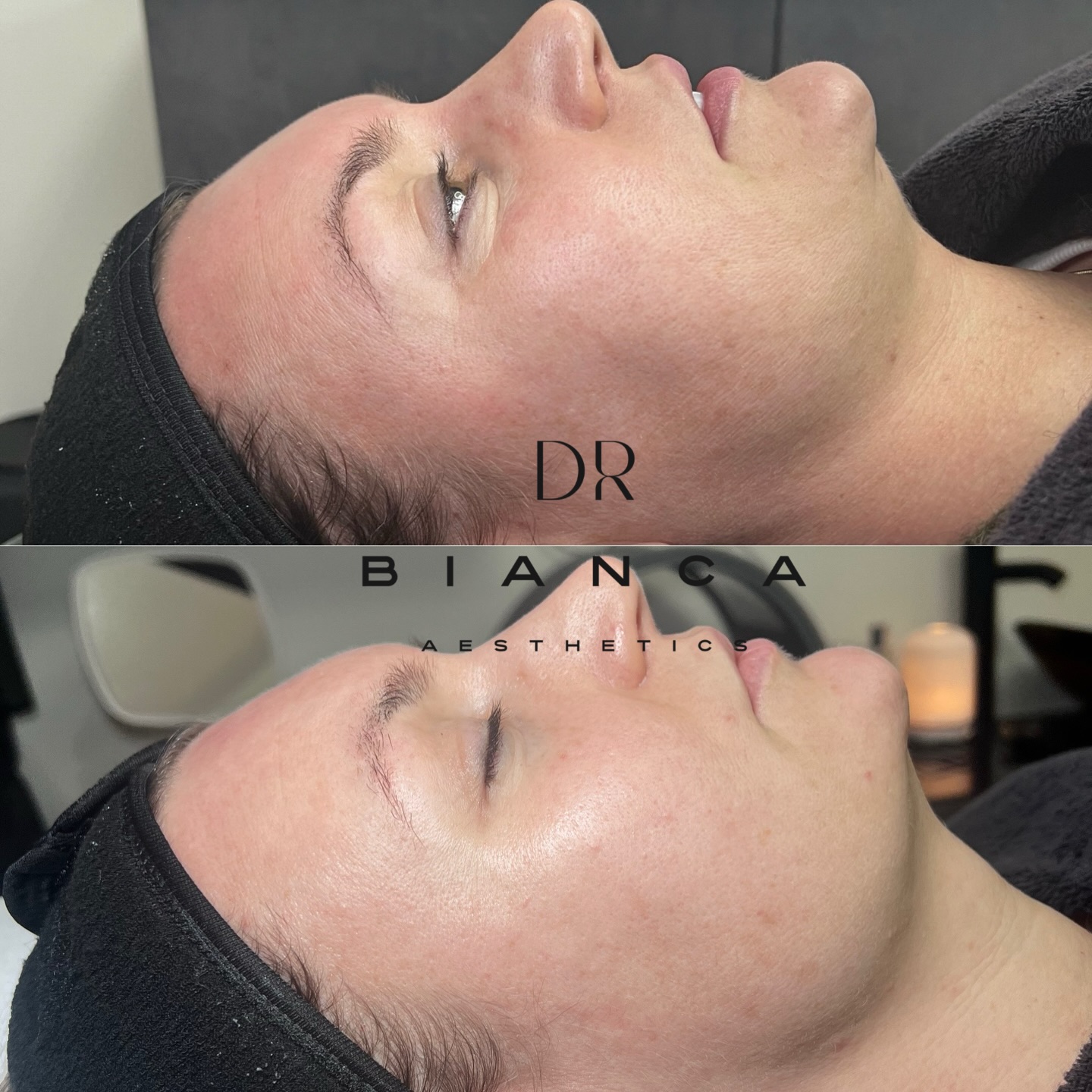 Glow, but make it natural ✨
Skinvive by Juvederm enhances skin quality from within—boosting hydration, smoothness, and radiance over time.
📍 Dr Bianca Aesthetics, Washington (North East UK)
📲 Book your consultation via the link in bio
🔗 www.doctorbianca.co.uk
#Skinvive #SkinQuality #NaturalResults #DrBiancaAesthetics #WashingtonUK NorthEastAesthetics