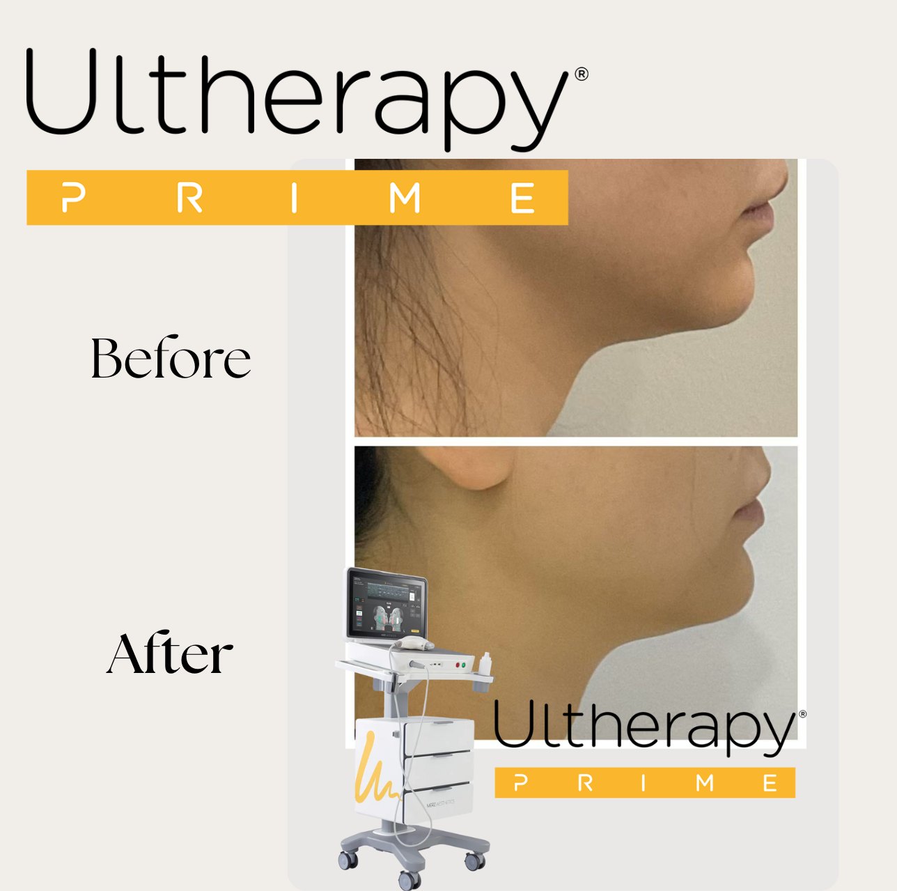 ✨ Utherapy Prime: The Ultimate Skin Reset ✨
Say goodbye to dull, tired skin and hello to a radiant, rejuvenated glow! 💆♀️✨ Utherapy Prime combines advanced technology with soothing precision to lift, tighten, and refresh your skin—because your confidence deserves to shine as bright as your complexion.
💡 Perfect for:
✔️ Lifting & firming
✔️ Smoothing fine lines
✔️ Restoring youthful radiance
Ready to glow from within? Book your session today! 🌟
#UtherapyPrime #SkinRejuvenation #GlowUp #HealthySkin #PlusScalpAndSkin #RadianceRedefined