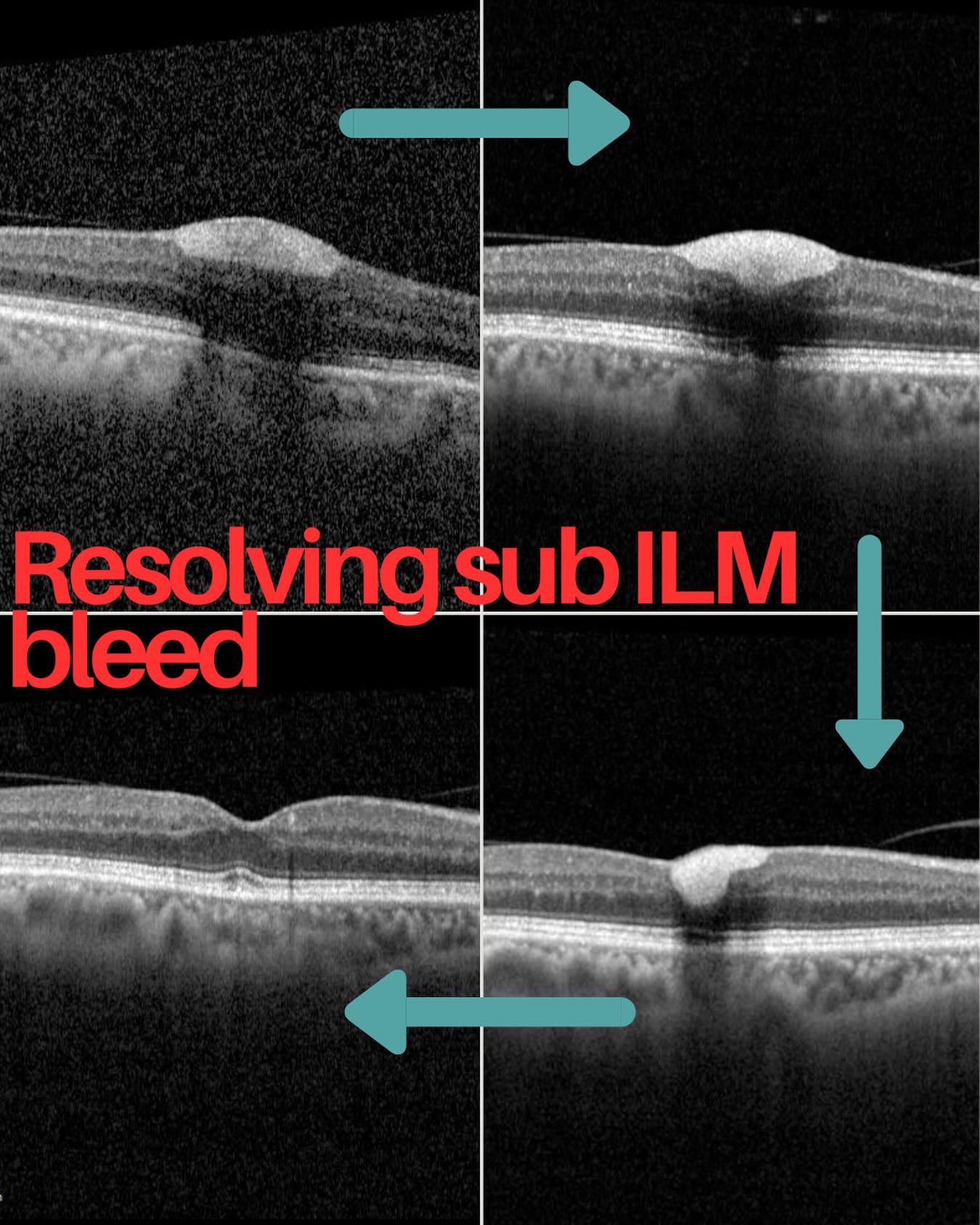 Sub-ILM bleed is a bleed under the internal limiting membrane (ILM) just above the retinal nerve fiber layer. It can be often mistaken for sub-hyaloid haemorrhage. This is because blood trapped under the ILM can be toxic to the retina if left too long.
Common causes includes:
• Valsalva retinopathy
• Terson syndrome
• Retinal arterial macroaneurysm rupture
• Trauma
• Hematologic disorders
Most patients present with sudden painless central visual loss. They are quite well-defined with a dome-shaped premacular haemorrhage configuration.
In most cases with a small bleed, observation is all that is needed. In the post above, the patient recovered to 6/9 Snellen vision within a few months.
In some cases with dense haemorrhage, vitrectomy with ILM peeling will be needed to allow faster visual recovery and reduce the risk of retinal toxicity from the blood.
#retina #ophthalmology #eyedoctorchng
