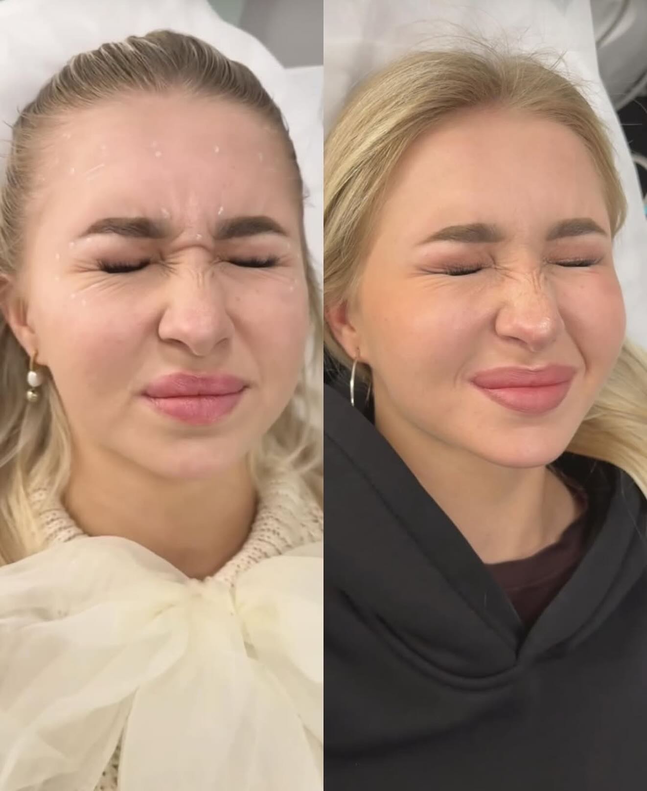 Botox für frisches Aussehen🌸
#botox #deincosmetologist #beauty #tübingen #rottenburgamneckar