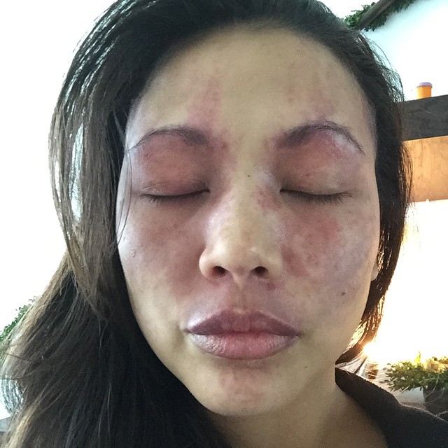 November 21st 3014 day ten after pulse dye ... I am completely healed from the laser . There are two new blebs (mini granulomas). I don't really see a lightening or blanching of any of the treated areas. I am having my second treatment on the 25th on my legs and only partial face. #portwinestain #sturgeweber #sws #pulsedyelaser #birthmark #prettyinpink