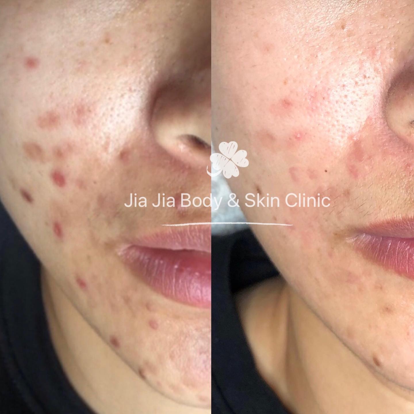 Concern - Acne, Acne Marks & Uneven skin tone
āHow did we treat it - signature acne treatment & Peel
š®Results - After 6 sessions
ā° Time taken - 3 months
šØThe area treated - Face
š Note - Results may vary person to person
#Acne is something anybody would avoid if one had a choice. It also contributes to emotional distress. However, acne can be successfully treated with the right #medication and #treatments. It is always ideal to consult an expert therapist especially when the acne is severe. Acne can also cause scarring and leave red or #brownmarks and #unevenskin tone, which should be addressed only after a personās active acne is under control.
Here is our client who got the combination acne
#acnetreatment #acnepositivity #acnesolutions #acnescars #acnemarks #adultacne #clearskin #exfoliation #acnejourney #skincareobsessed #skinblemishes #acneproblems #acnetips #realresults #realresultsrealpeople #beforeafter #skin #pimples #acneproneskin #acnecommunity #sensitiveskin #acnefree