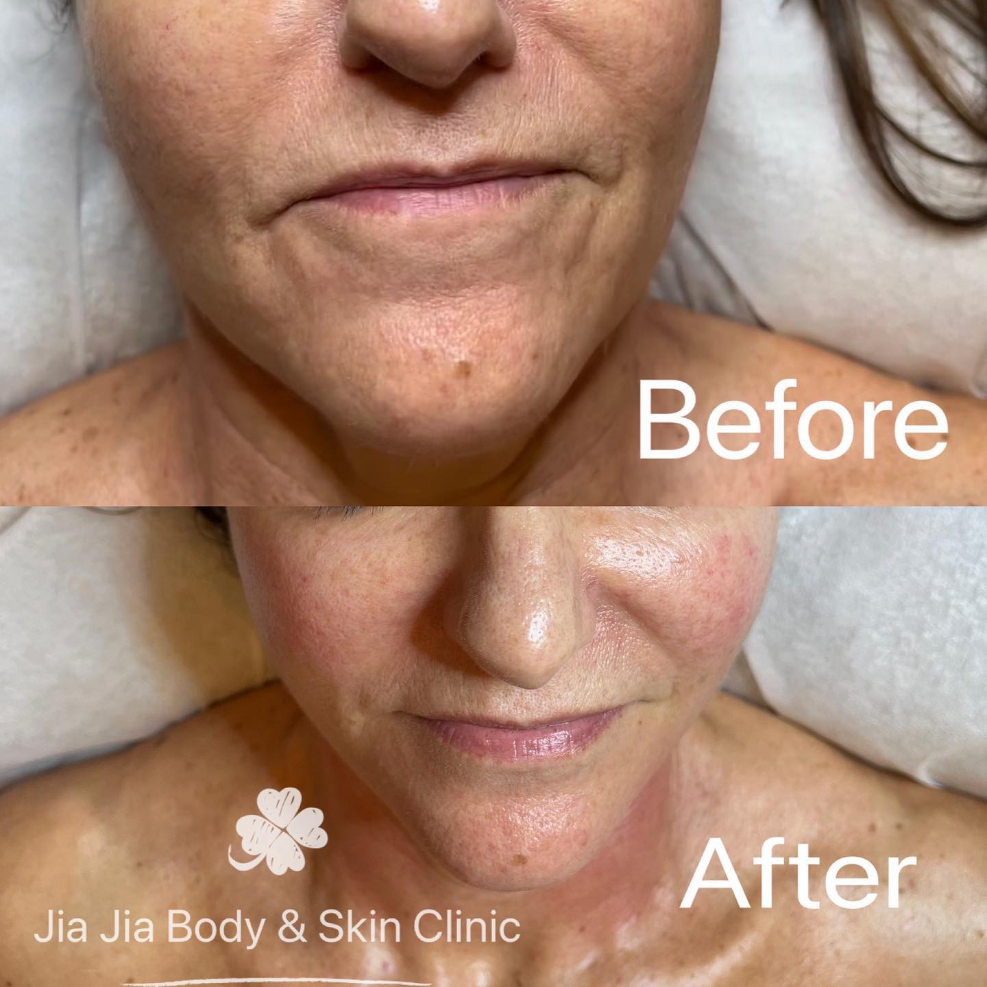 SKIN Laxity with NIR
Immediately tightens the skin with noticeable results that last up to 2 years!
After just 24 hours, you will see improvement in skin texture as it continues to smooth out and plump up leaving your skin with a radiant glow.