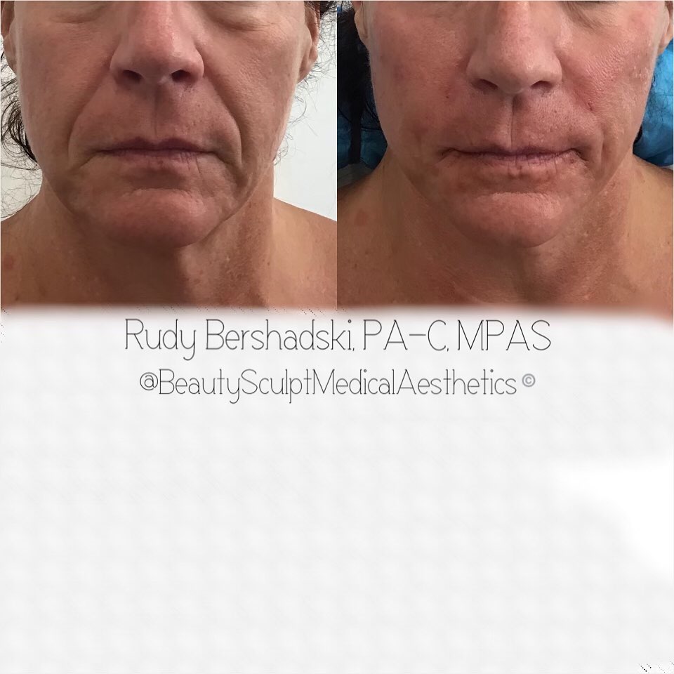 #Hyaluronicacidfillers volume repletion in treating cheeks, nasolabial folds, marionette lines and oral commissures.
Ready for the ultimate rejuvenation experience? 📞 239-777-5002 for a complimentary consultation.
.
.
.
____________________________
#fillers #rejuvenate #beforeandafter #combinationtherapy #medicalaestheticsnaples #rudybershadskipacmpas #knowyourinjector #beautysculpt