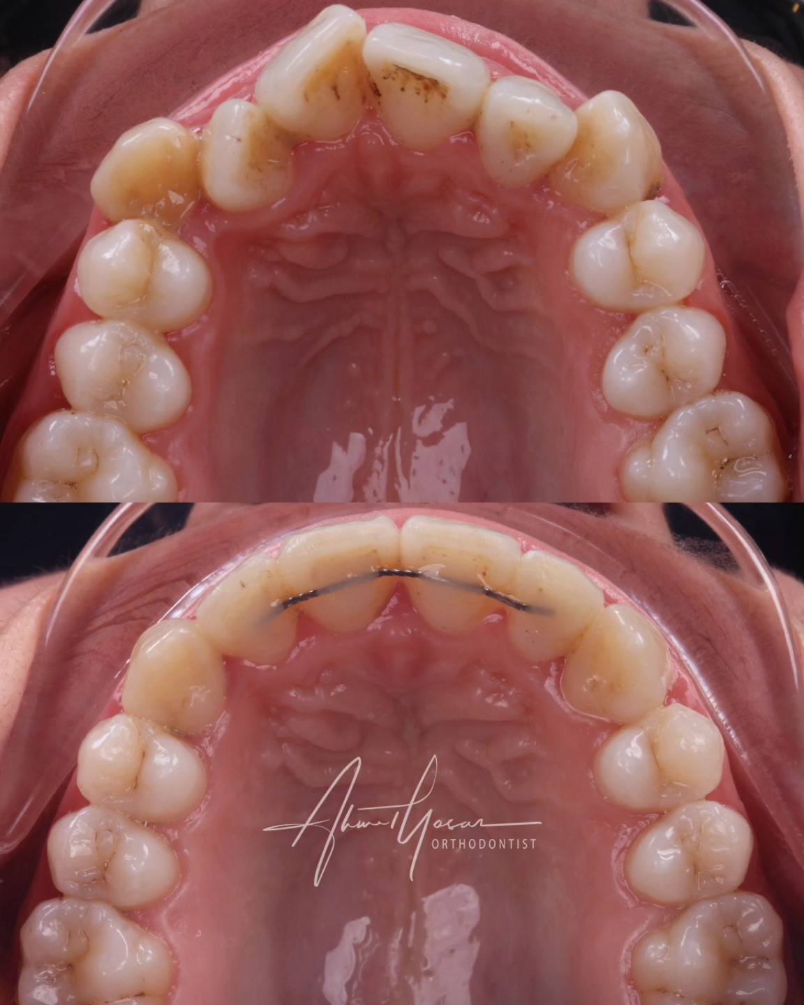 Şeffaf plak tedavisi / Clear aligner case.
.
Our clinic is authorized by the Ministry of Health of the Republic of Türkiye for International Health Tourism. All patients have been informed and have provided consent for the use of their photographs on our social media platforms. All content shared on social media is intended to inform patients about procedures and should not be perceived as advertising. Outcomes of any surgical or interventional treatment may vary from person to person. It is recommended to consult your physician for detailed information before undergoing any procedure.
.
#ortodonti #ortodontist #bursa #bursaortodonti #bursaortodontist #bursaortodontiuzmanı #orthodontics #braces #teltedavisi #dişteli #orthognathicsurgery #invisalign #clearcorrect #şeffafplak #lingualortodonti #dişteli #çeneameliyatı #selfligating #kapaklıbraket #gülüştasarımı #dent #dentistry #photography #estetik #dentalart #ahmetyasar #drahmetyasar