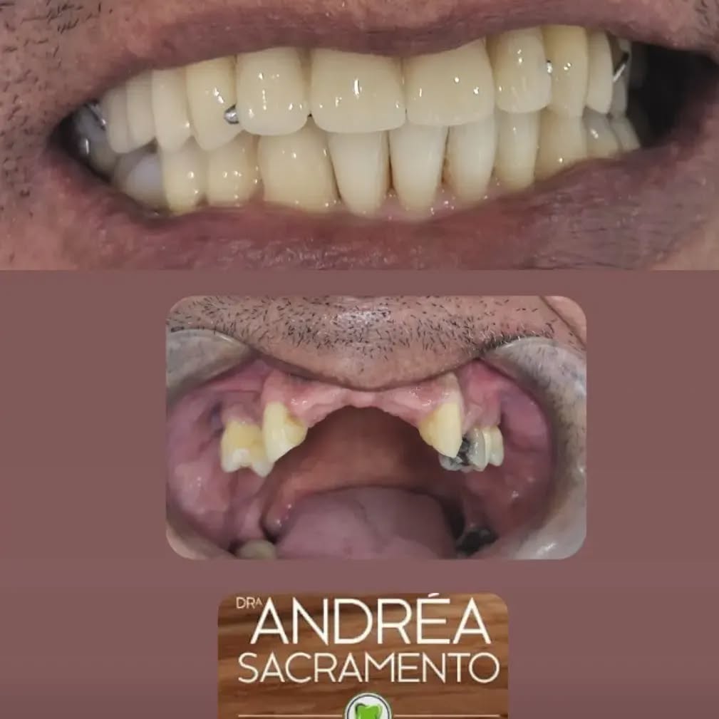 Uma das opçoes para recuperar seu sorriso e sua autoestima.
Prótese Removível