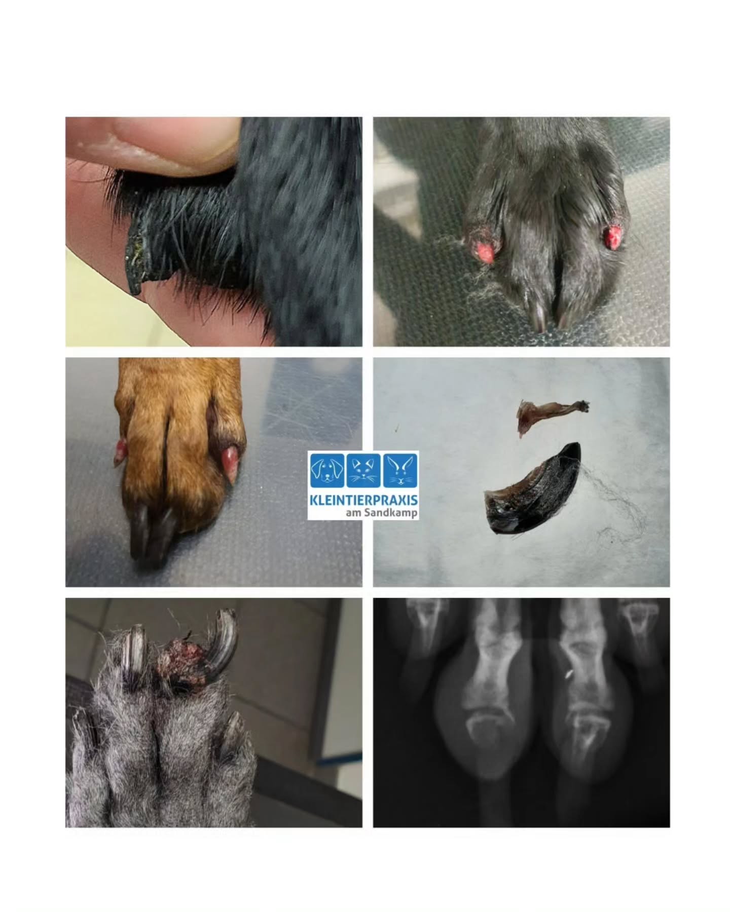 Unser Thema der Woche sind Krallenverletzungen durch unterschiedliche Ursachen. Sei es durch ein Trauma, bei dem das Horn (Krallentüte) inklusive eines Teils des knöchernen Krallenbeins abbricht oder nur die Hornsunstanz einreisst (entweder quer oder in Längsrichtung) oder Erkrankungen, bei denen aufgrund von Entzündungsprozessen das Krallenhorn einfach abfällt (zum Beispiel SLO) oder es wächst ein bösartiger Tumor in der Zehe (Hinweis sind Knochenauflösungen, die auf dem Röntgenbild erkennbar sind).
In den meisten Fällen leiden unsere Patienten stark unter den Symptomen. Manchmal müssen wir sie für die Behandlung in Narkose legen, weil die notwendige Behandlung zu schmerzhaft sein würde.
In jedem Fall ist das richtige Anlegen eines Pfotenverbandes unerlässlich für die Heilung. Eine ausreichende Polsterung zwischen den Zehen inklusive der Daumen- (Vordergliedmaße) bzw Wolfskralle (Hintergliedmaße) ist notwendig, um keinen Verbandsschaden anzurichten. Als Beispiel wie schnell es zu ernsthaften Schäden kommen kann zeigen die Bilder von einem Hund dessen Verband unsachgemäß angelegt und für drei Tage belassen wurde. Zum Glück heilen auch diese Wunden und der Patient hat sich mittlerweile an uns und das Prozedere gewöhnt und kommt trotz der Unannehmlichkeiten gerne zu uns ☀️👩🏼⚕️
#Tierarzt
#Oldenburg
#Krallenverletzung
#Hundegesundheit