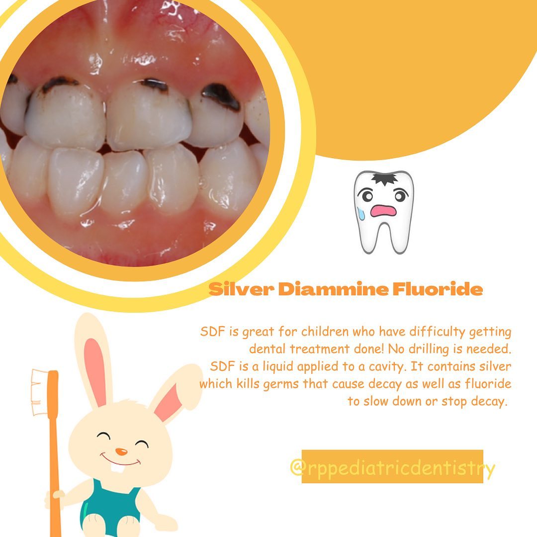 We use SDF on our patients who are unable to get treatment done. Parents should know that the medication does turn the decay spot Black permanently, but if applied to a baby tooth it will not stain the permanent tooth. Just one of our ways to fight decay! #pediatricdentistry #marylanddentist #riverdaleparkmd #pediatrics #pediatricdentist