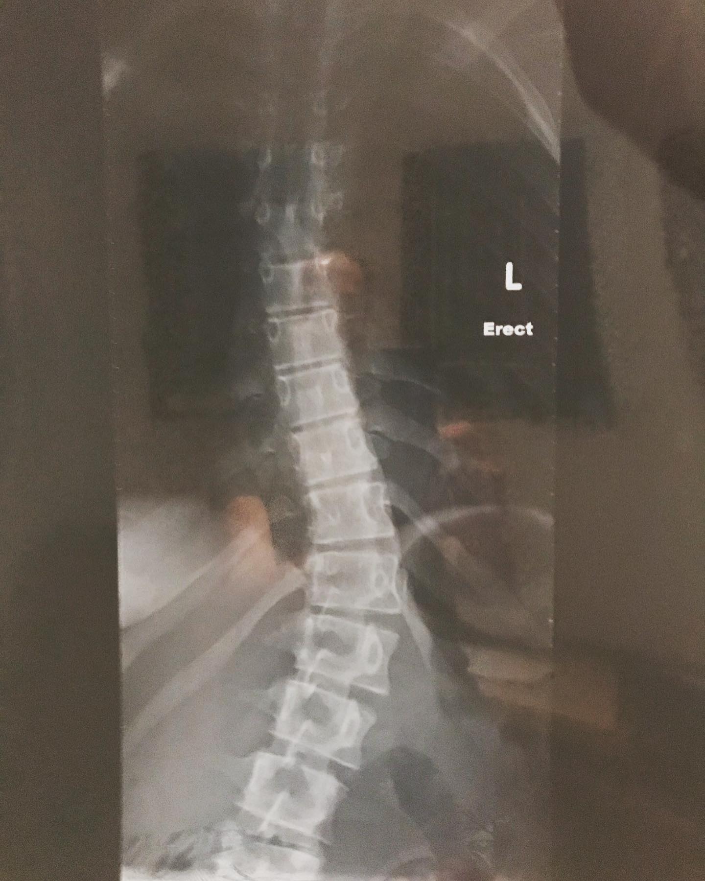 June is Scoliosis Awareness Month. Did you know that we specialise in exercises specific to Scoliosis?
_
Regular Pilates or Yoga exercises are not always suitable for someone with Scoliosis. Scoliosis is a three dimensional condition that requires corrections made across all planes. We can help you understand your curvature and what movements would assist to decrease your curvature and potential for pain, and also the exercises you should avoid.
_
“Even if a client has a mild Scoliosis, it should not be ignored as studies have shown that if you apply scoliosis specific exercises before the Cobb Angle reaches 30 degrees, you can have a significant impact on the stability of the curve and slow or even stop progression in some cases. We call this the Critical Threshold.” @scolio_pilates_helennew
_
Nadine has completed Module 1&2 of the @scolio_pilates course with Karena Thek, and now that travel is a little easier looks to continue these studies. She has also done some additional work with Scoliosis Physiotherapist, Ashleigh Prowse from @scoliosisandspineclinic in Brisbane.
_
We can work with you and your Physiotherapist, Osteopath or Chiropractor, to help you find the right moves to meet your specific needs.
_
#pilatesandmovement #pilatesandmovementsunshinecoast #pilates #scoliosis #schroth #scoliosisexercise #scoliopilates #pilatessunshinecoast #sunshinecoastpilates #yogasunshinecoast #sunshinecoastyoga #dancesunshinecoast #sunshinecoastdance #movesunshinecoast #healthandfitnesssunshinecoast #sunshinecoasthealthandfitness #healthandwellnesssunshinecoast #sunshinecoasthealthandwellbeing