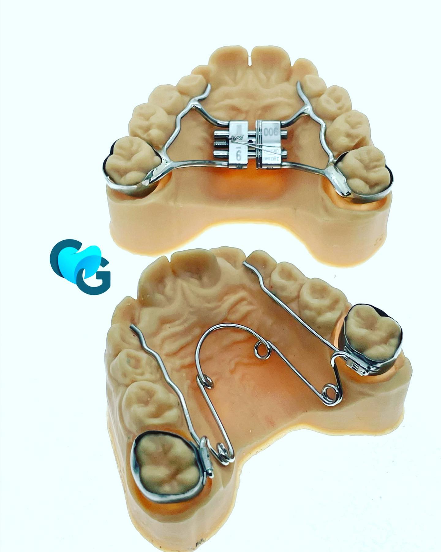 Expansion palatine fixe et amovible #ortho #orthodontie #orthodontiefixe #expansionpalatine #expansionforcee #orthopassion #quadhelix #leafexpander #hyrax