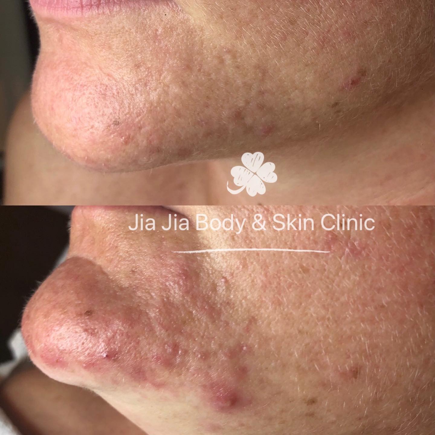 šConcern - Acne, closed comedones
āHow did we treat it - signature acne treatment
š®Results - After 1 sessions
ā° Time taken - 1 week
šØThe area treated - Face
š Note - Results may vary person to person
#acnetreatment #acnepositivity #acnesolutions #acnescars #acnemarks #adultacne #clearskin #exfoliation #acnejourney #skincareobsessed #skinblemishes #acneproblems#realresults #beforeafter #skin #pimples #acneproneskin #acnecommunity #sensitiveskin #acnefree #blackhead #comedone #extractions #acnetreatment #laser #skincare #blemishes #acne #skintagremoval #drpimplepopper #clearskin