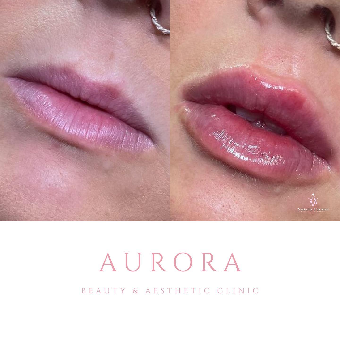 Lip filler 💋
✨1.1ml Revolax deep
✨£180
✨Lasts up to 18 months
