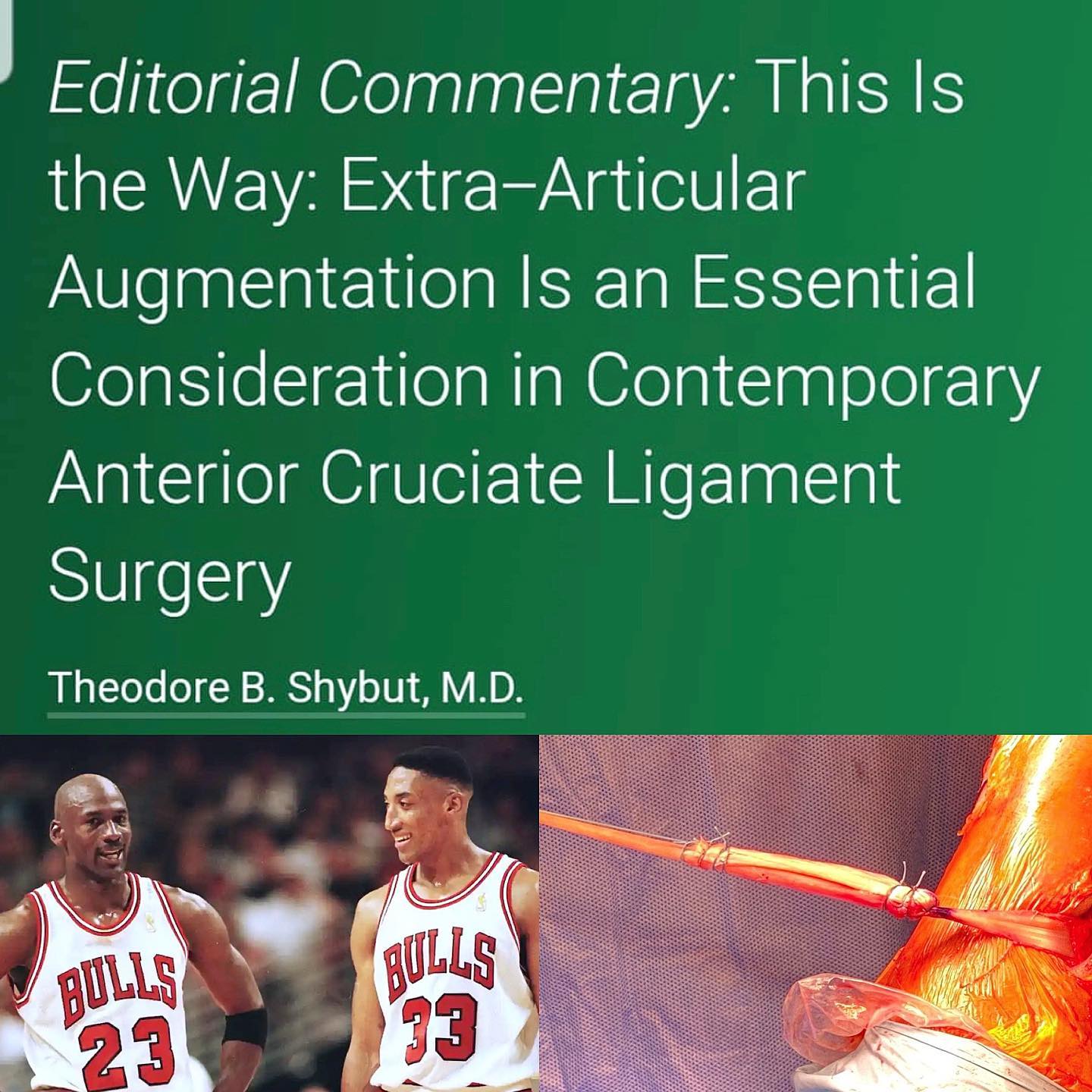 As a knee surgeon, I truly integrated Anterolateral Ligament Reconstruction in my daily practice. “Might ALL reconstruction prove to be Scottie Pippen to the ACL’s Michael Jordan? I think this most recent systematic review votes “Yea,” and I do not think we will see the last dance of the ALL for a long time.” #santigroup #sportsmedicine #kneesurgery #aclreconstruction #allreconstruction