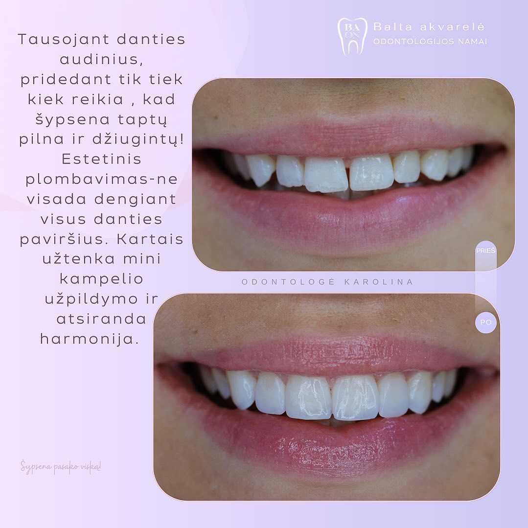 Nuostabios pacientės - nuostabi šypsena ! 💗
#smile #newsmile #eastetic #easteticdentistry #estetineodontologija #esetinisplombavimas #estetinisplombavimasklaipedoje #odontologijosklinikaklaipėdoje