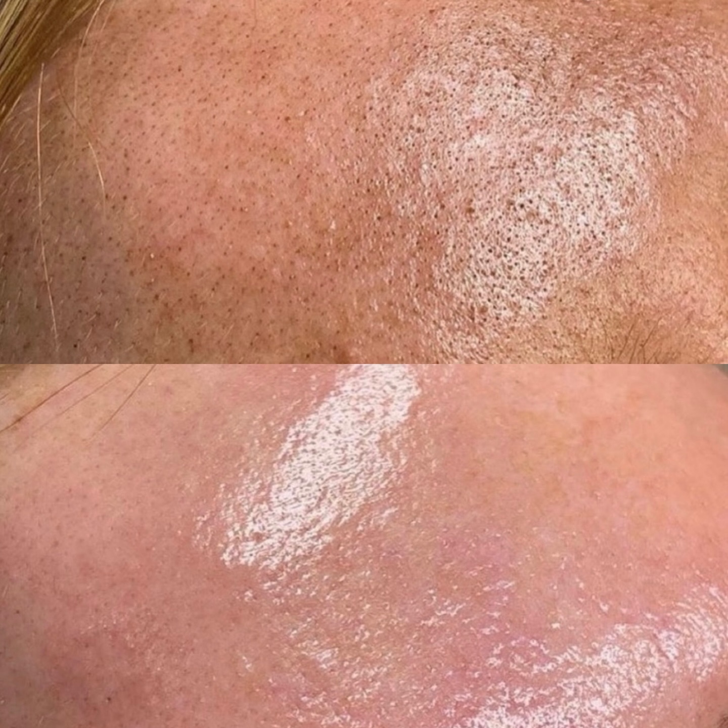 Von verstopften Poren zu strahlender Haut – Die Verwandlung beginnt mit der richtigen Pflege. #GlowUp ✨ Vorher/Nachher